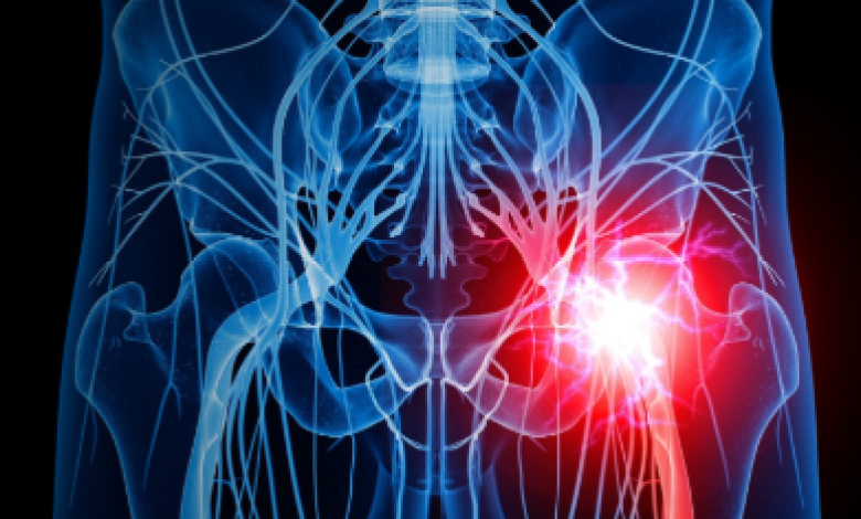 Sciatica Again! – BionicOldGuy Sciatica Again! – BionicOldGuy