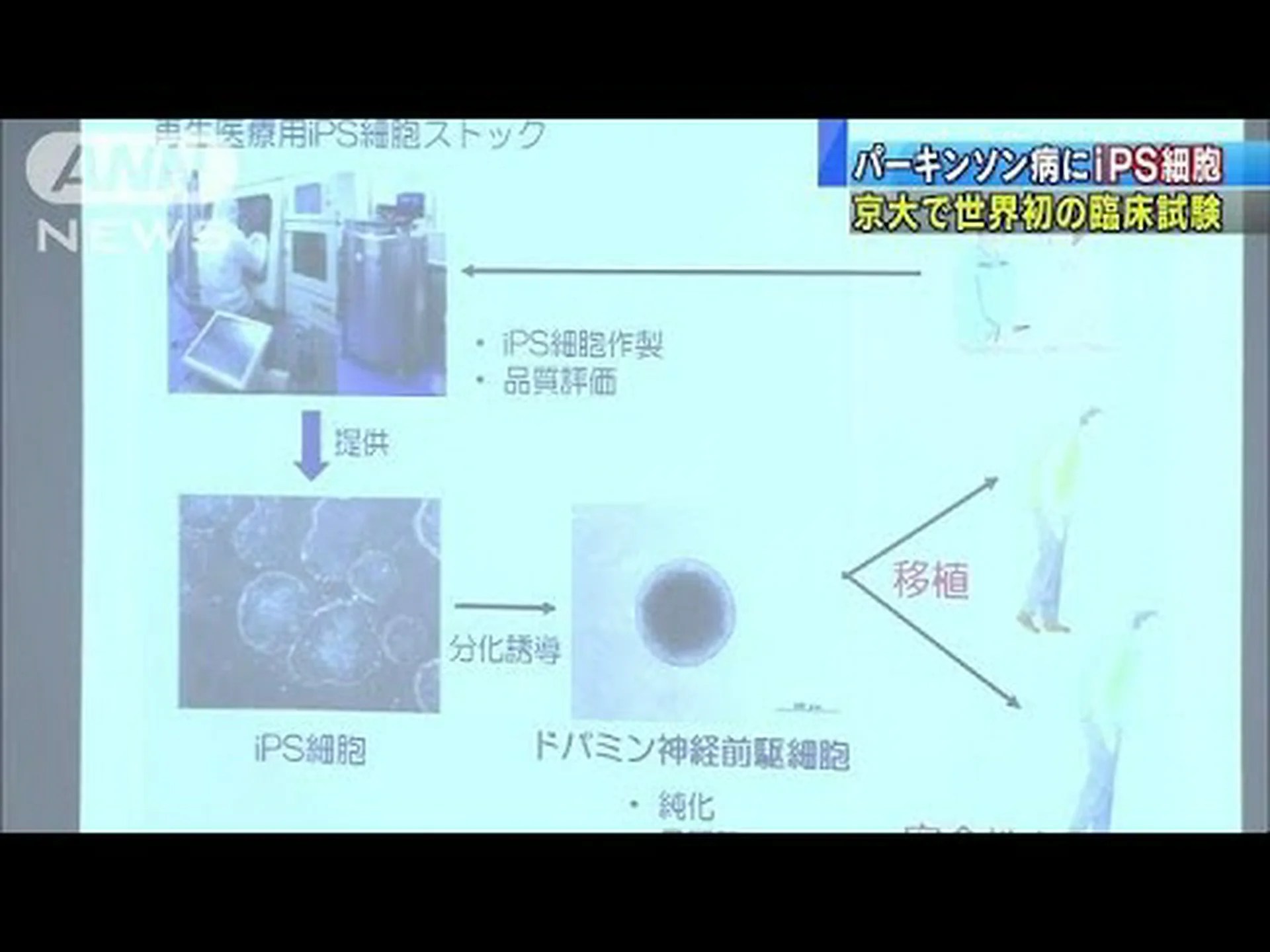 研究者:自分の脳の幹細胞を使ったパーキンソン病の治療が成功 研究者:自分の脳の幹細胞を使ったパーキンソン病の治療が成功