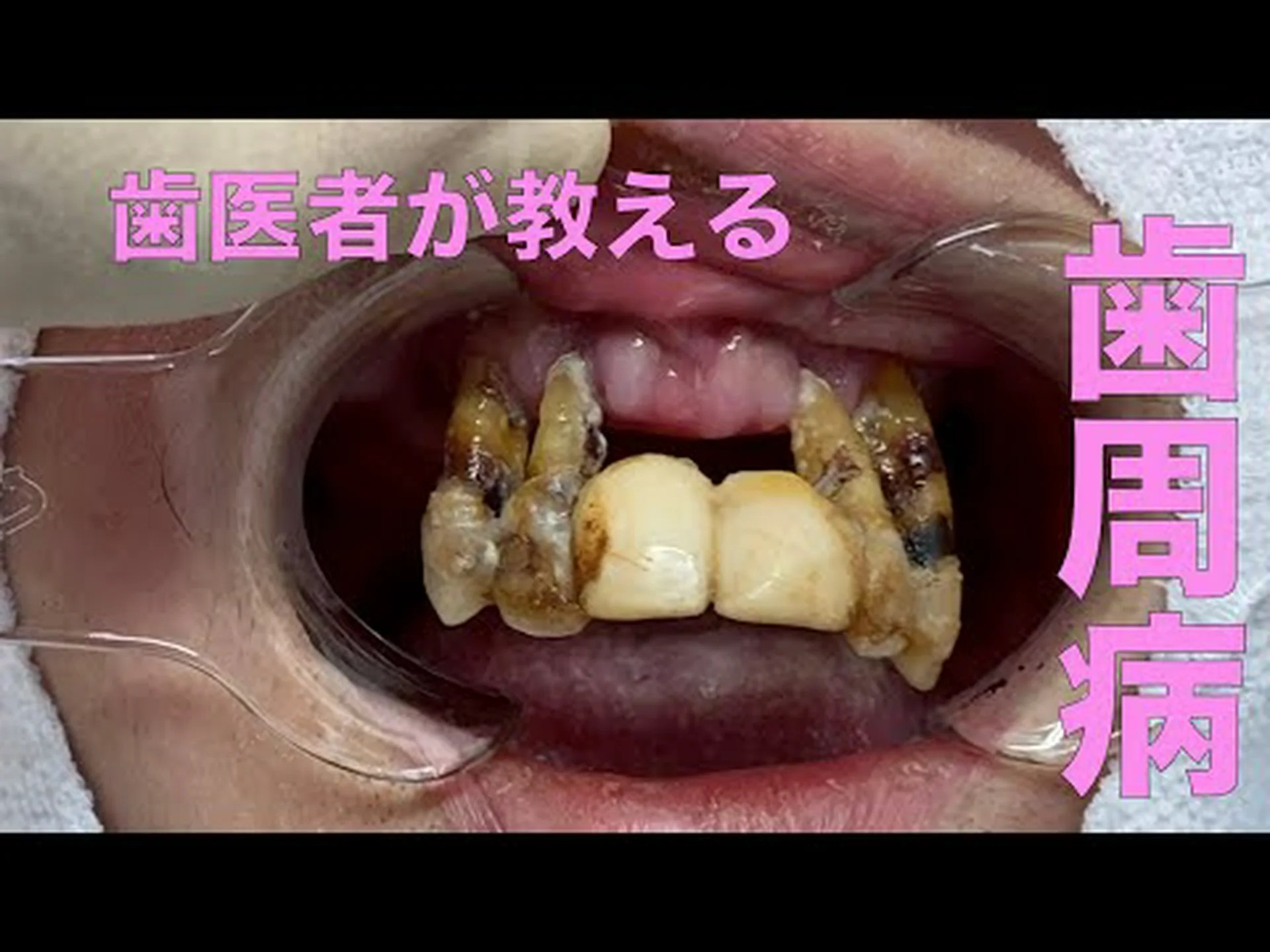 腐った歯は肺にダメージを与える 腐った歯は肺にダメージを与える