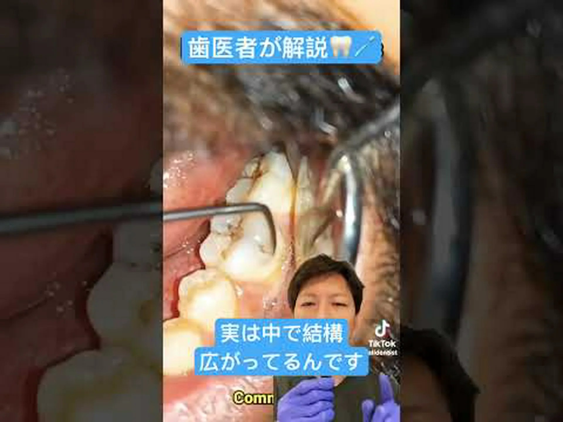 虫歯と闘いましょう! 虫歯と闘いましょう!