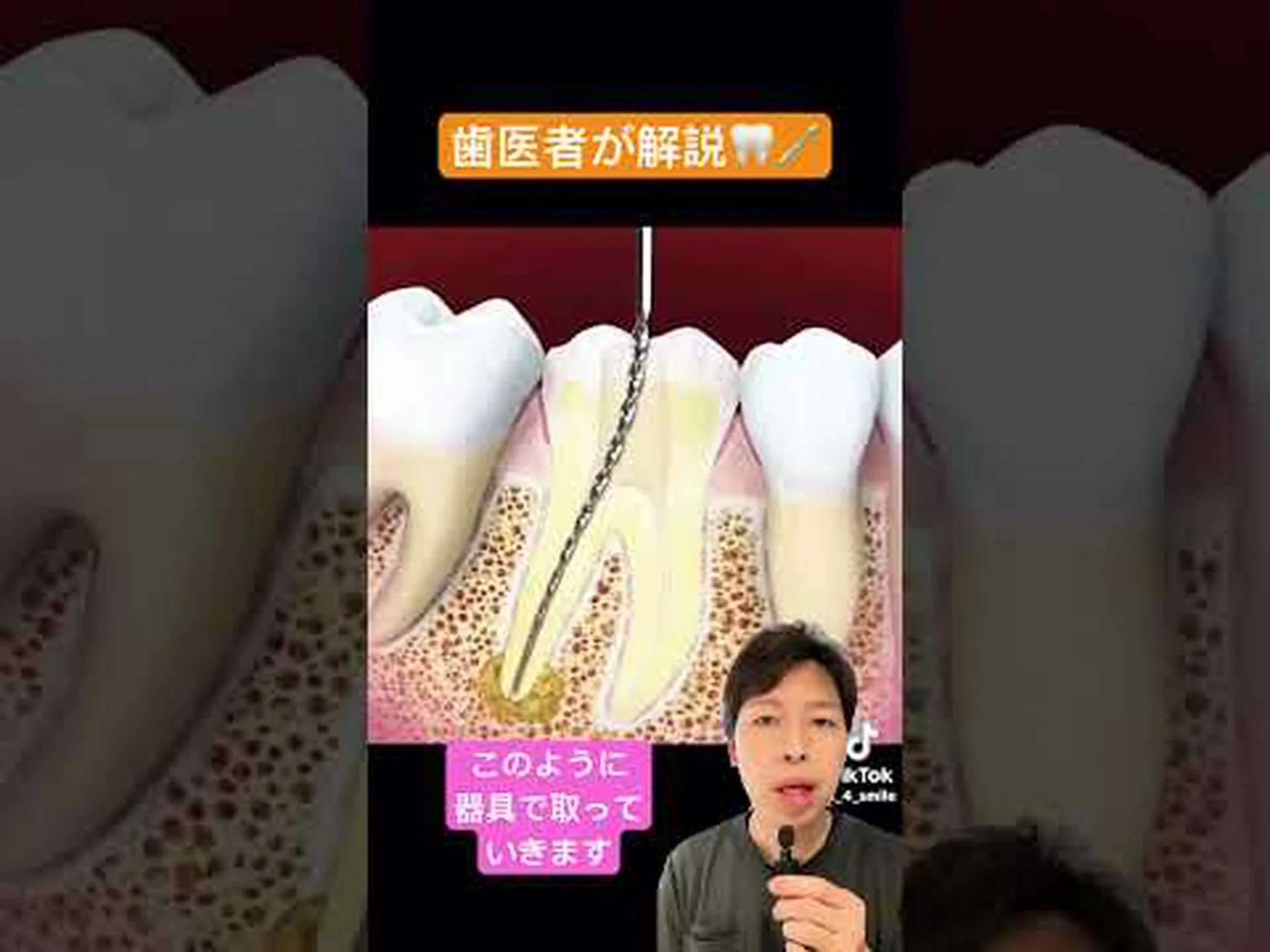 巨大口のためのバンジーコード神経 巨大口のためのバンジーコード神経