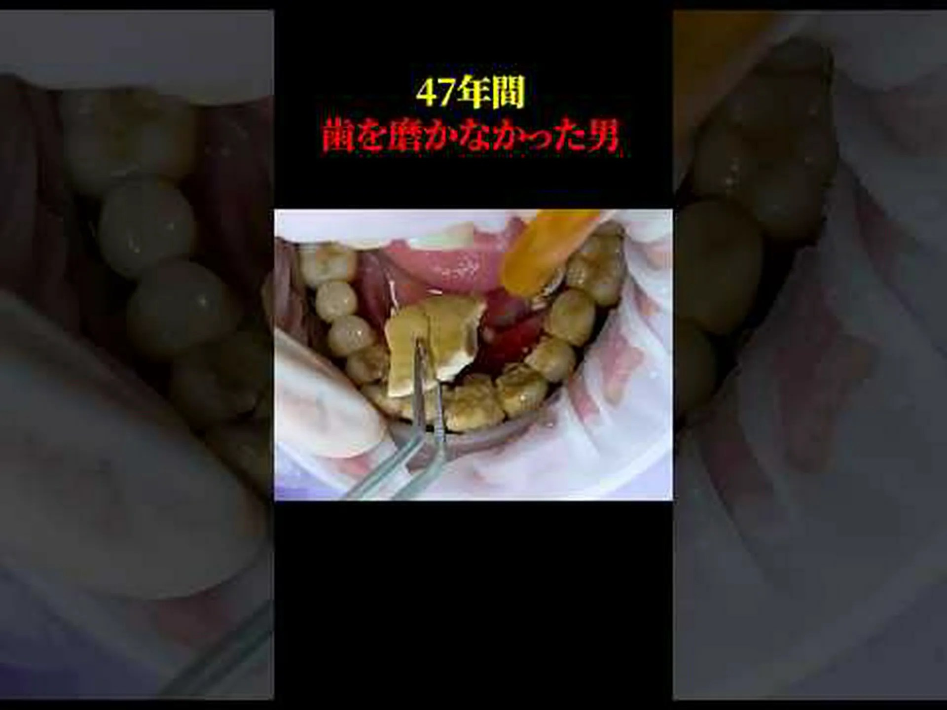 注射器の代わりに石膏 注射器の代わりに石膏