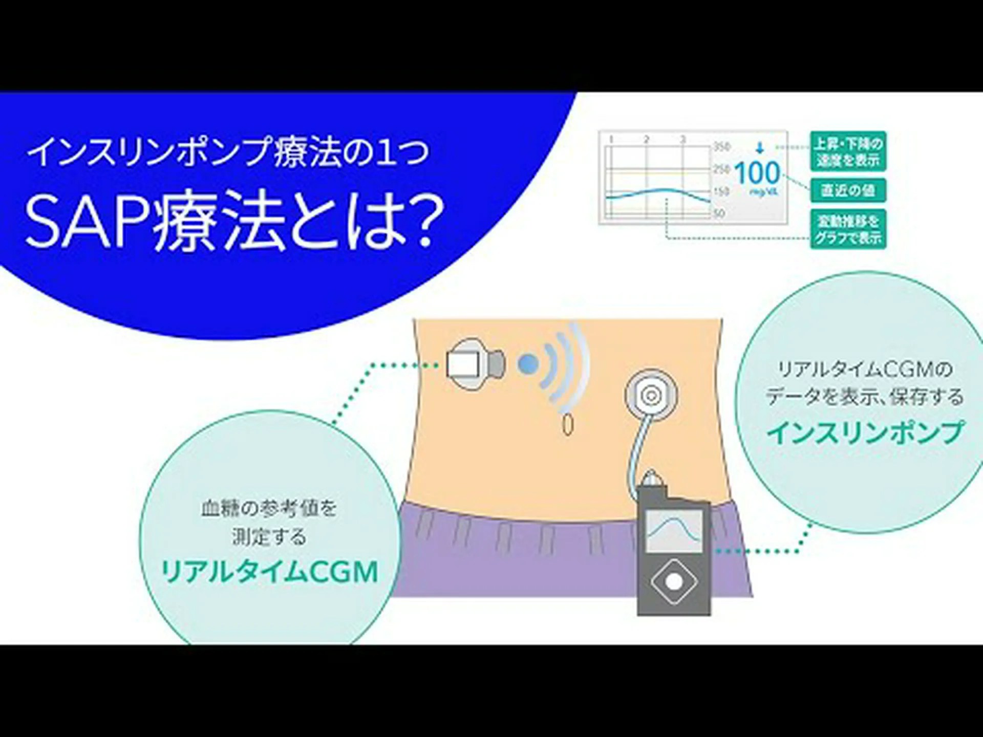 バイオセンサーは糖尿病治療の自動化を目的としています バイオセンサーは糖尿病治療の自動化を目的としています