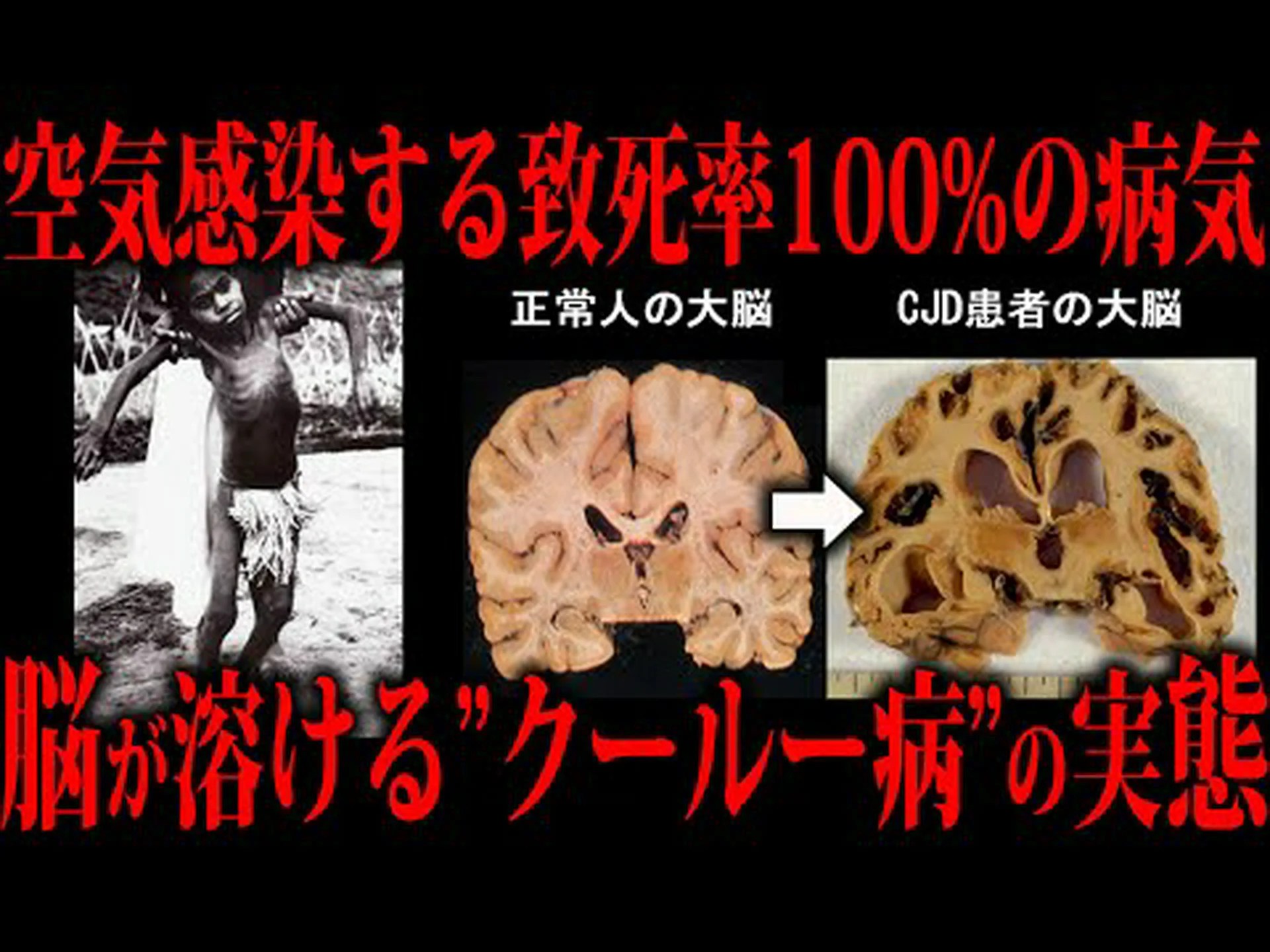 青少年の腸は増加した量のプリオンを吸収する可能性がある 青少年の腸は増加した量のプリオンを吸収する可能性がある