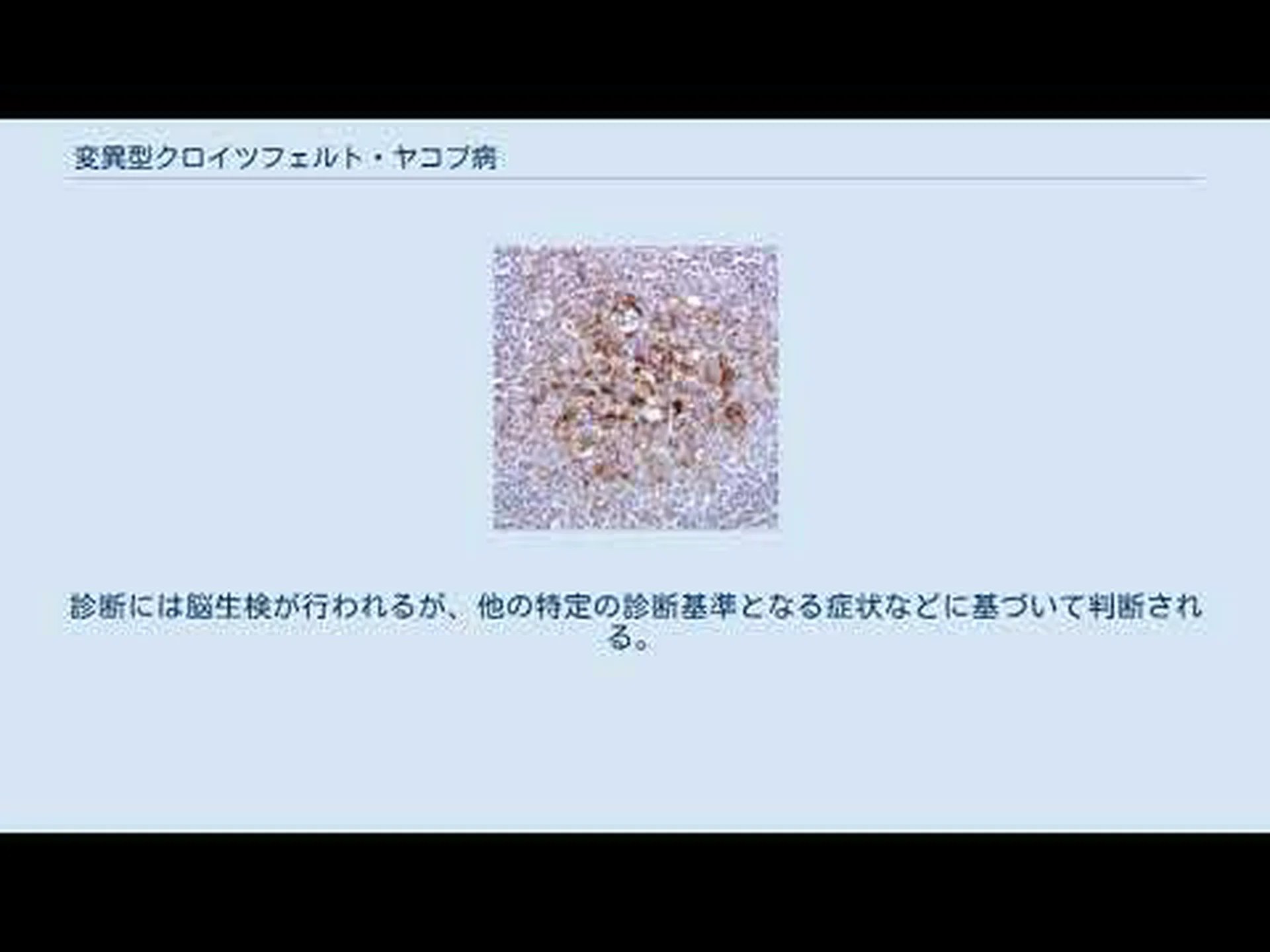 血液製剤はvCJDを伝染させる可能性がありますか? 血液製剤はvCJDを伝染させる可能性がありますか?