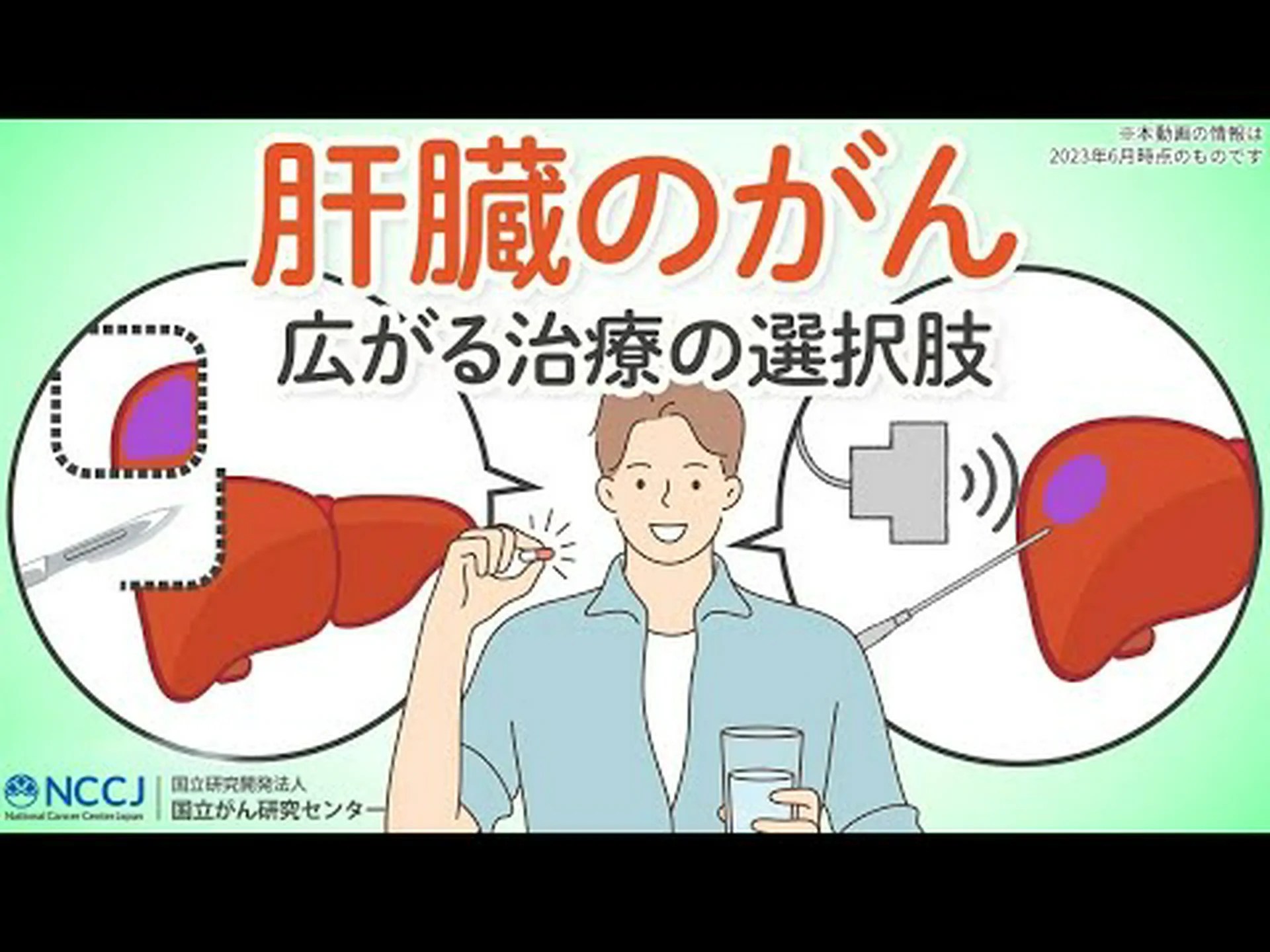 肝臓がんの新しい化学療法:有効成分が鼠径カテーテルを介して肝臓に到達 肝臓がんの新しい化学療法:有効成分が鼠径カテーテルを介して肝臓に到達