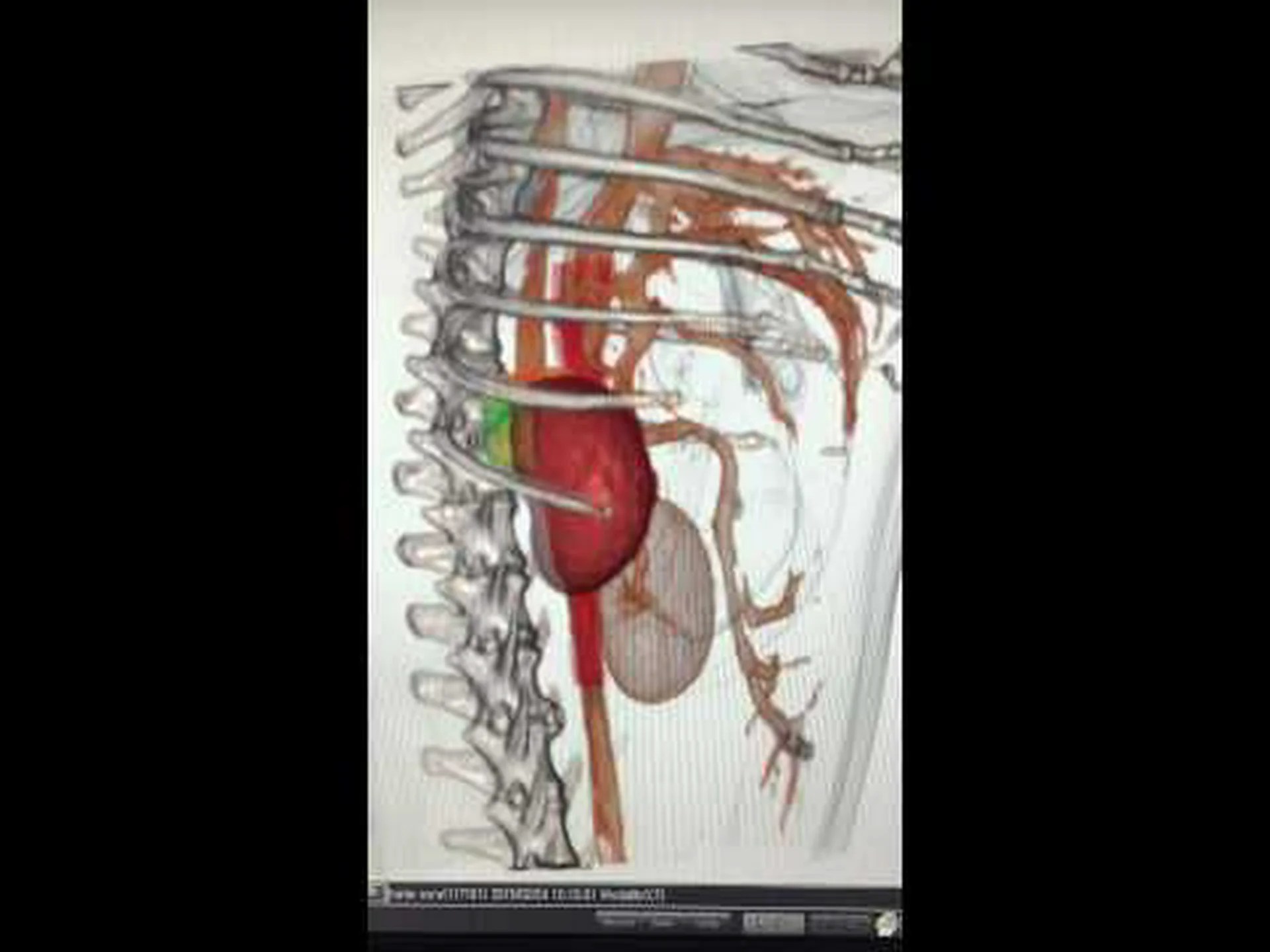 手術室の腫瘍の 3D 画像 手術室の腫瘍の 3D 画像