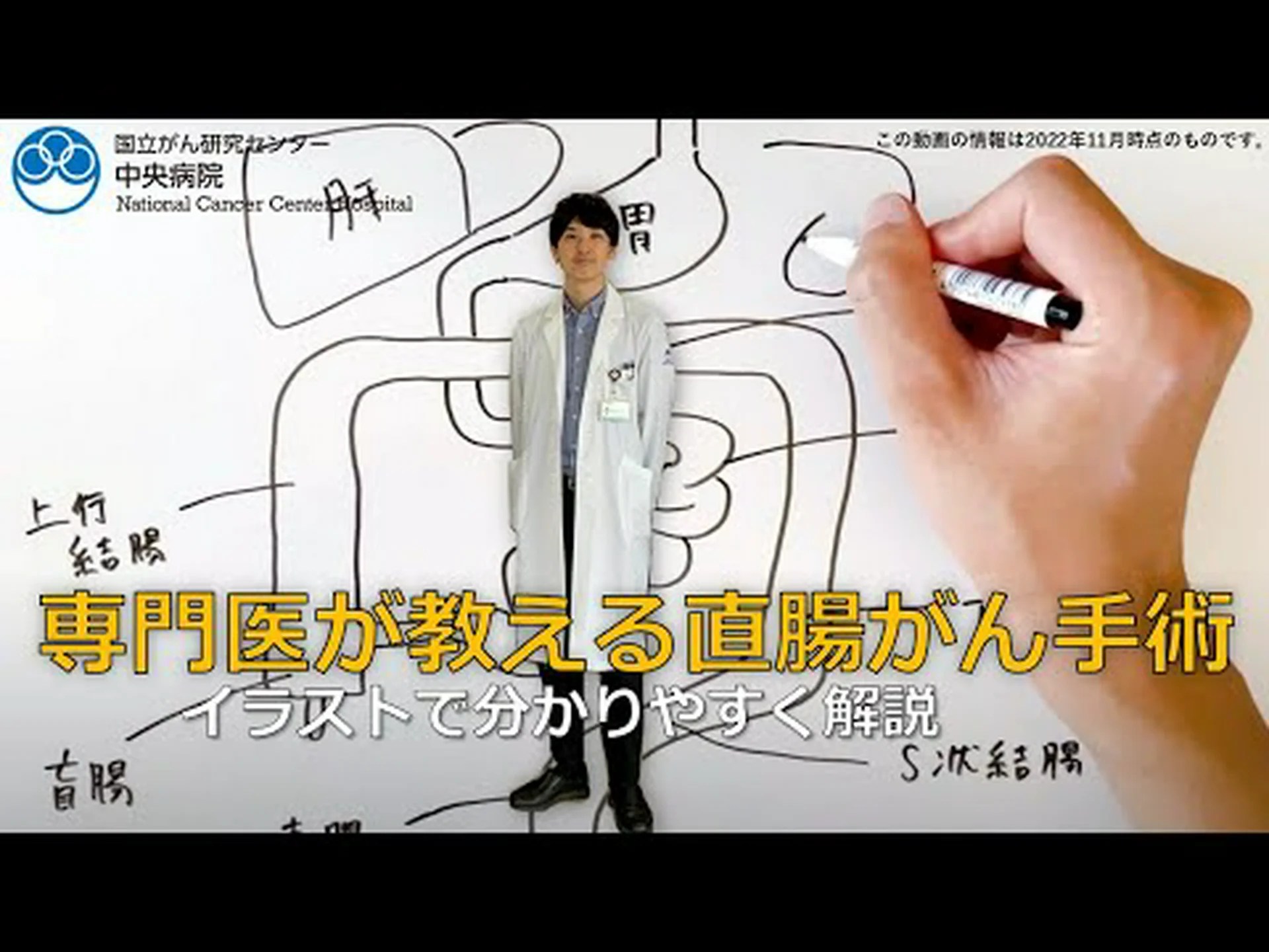 特殊な手術で直腸がんからの回復の可能性が高まる 特殊な手術で直腸がんからの回復の可能性が高まる