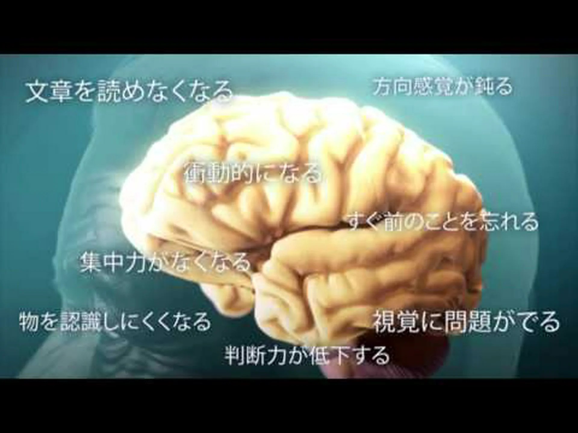 胸部のアルツハイマー病 胸部のアルツハイマー病