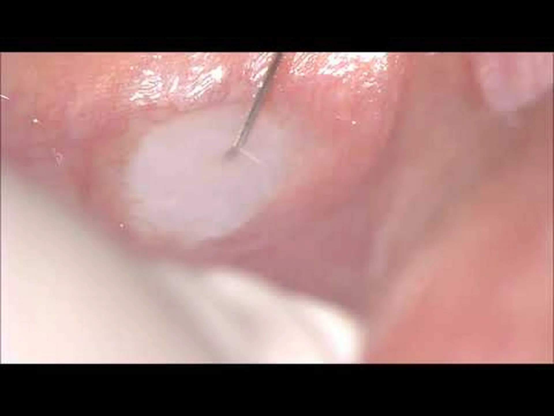 目の組織インプラント 目の組織インプラント