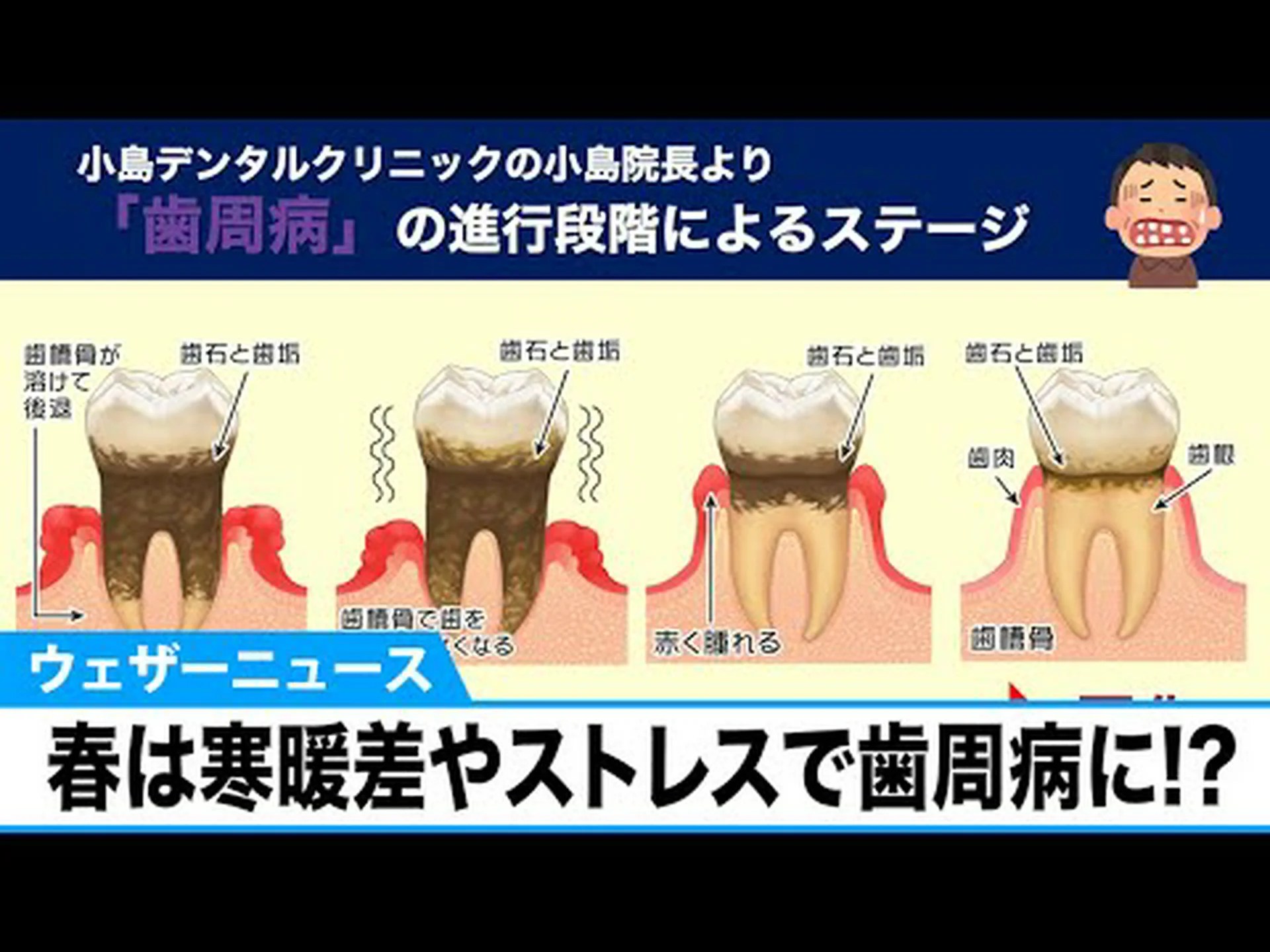 精神的ストレスが歯周炎を引き起こす可能性がある 精神的ストレスが歯周炎を引き起こす可能性がある
