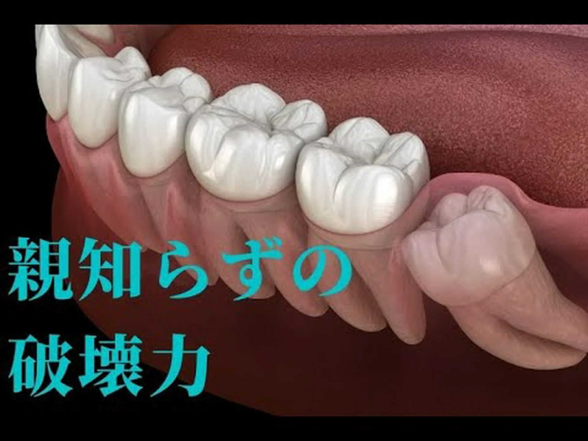 親知らずの噛み合わせが良い 親知らずの噛み合わせが良い