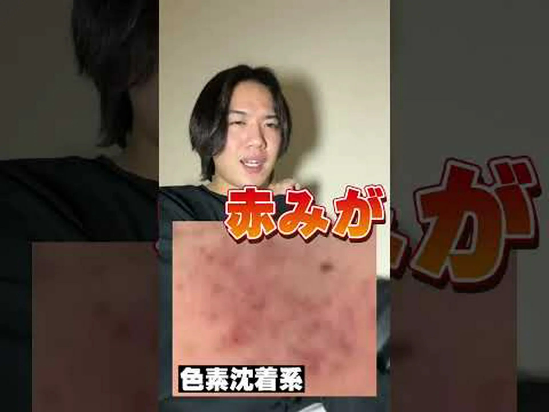 LEDでニキビ対策 LEDでニキビ対策