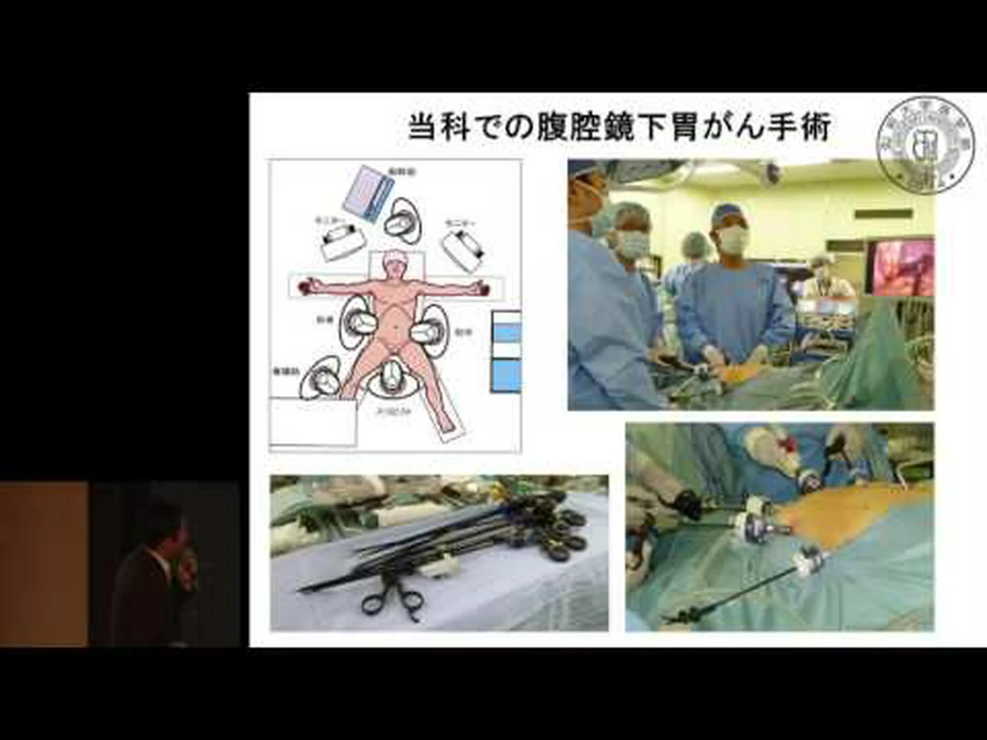 腹腔鏡検査の代わりに組織サンプルを採取 腹腔鏡検査の代わりに組織サンプルを採取