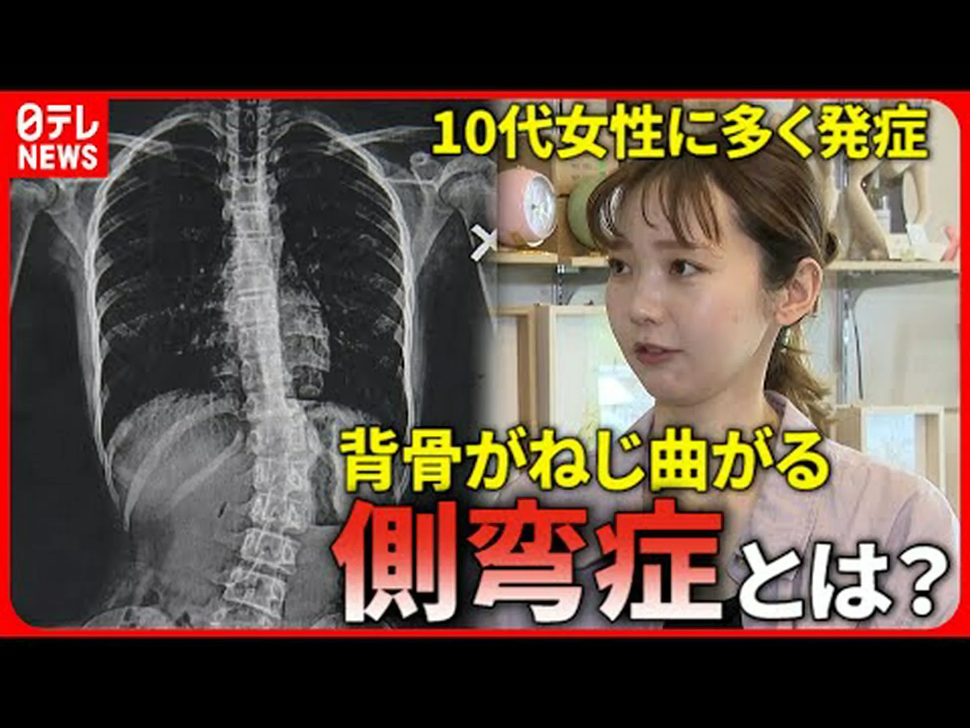 エリザベス女王の孫娘が側弯症についての意識を高め、手術跡を見せる エリザベス女王の孫娘が側弯症についての意識を高め、手術跡を見せる