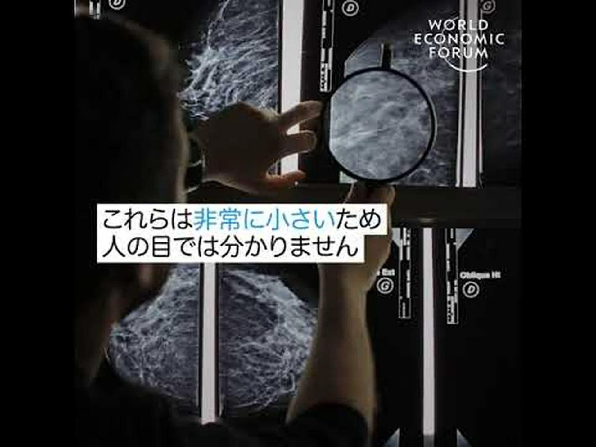 人工知能は乳がんが広がるかどうかを予測できる 人工知能は乳がんが広がるかどうかを予測できる