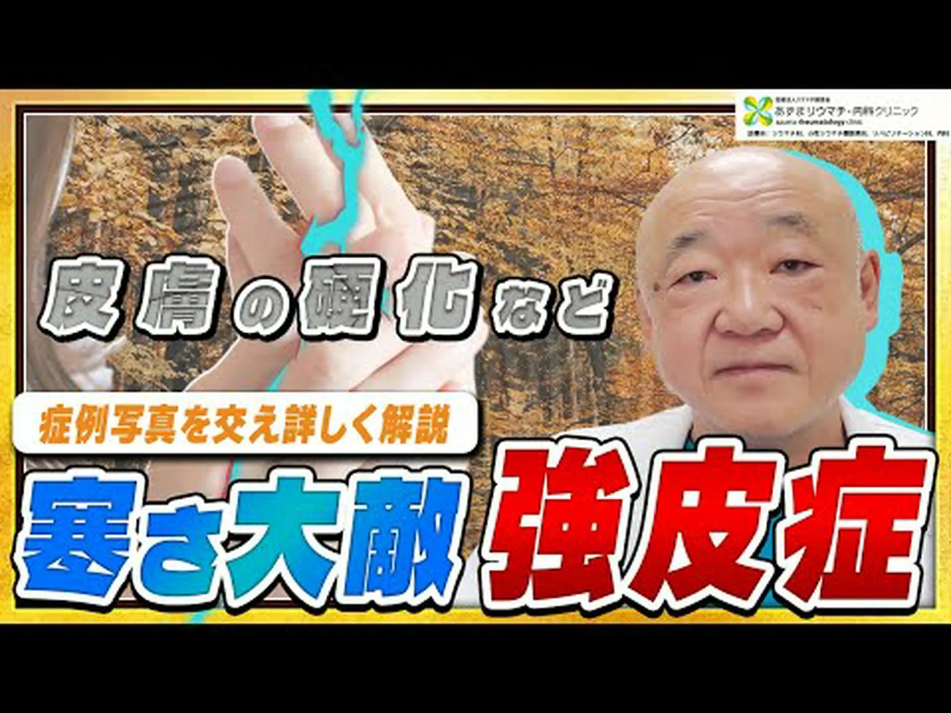 強皮症:それは何か、原因、症状、治療法 強皮症:それは何か、原因、症状、治療法