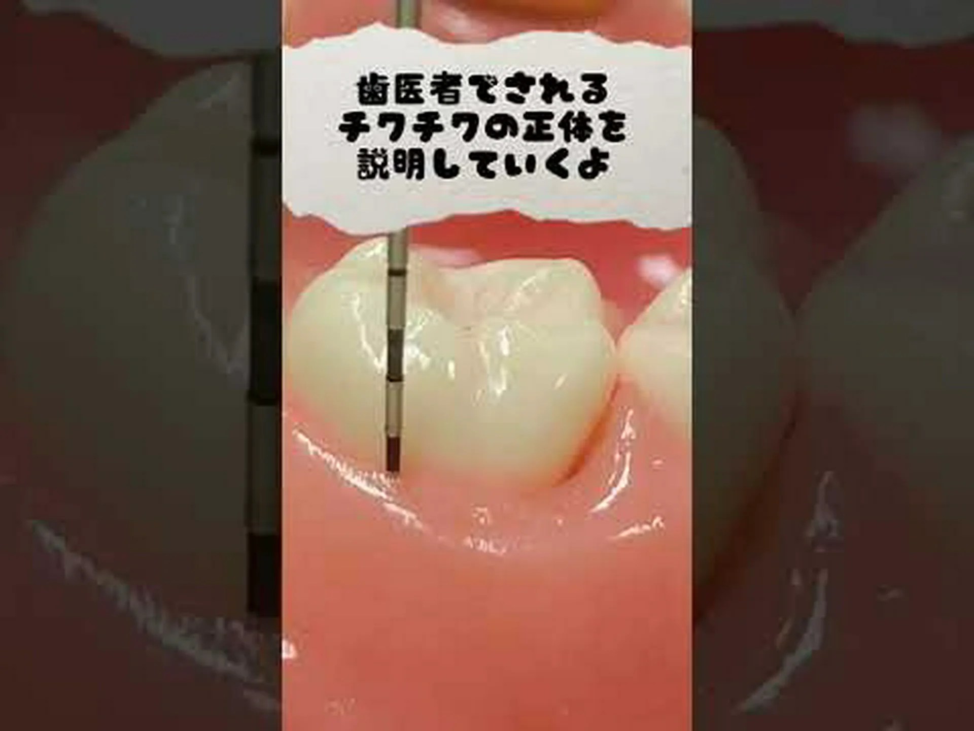 口の中のチクチク感 – その原因と対処法 口の中のチクチク感 – その原因と対処法