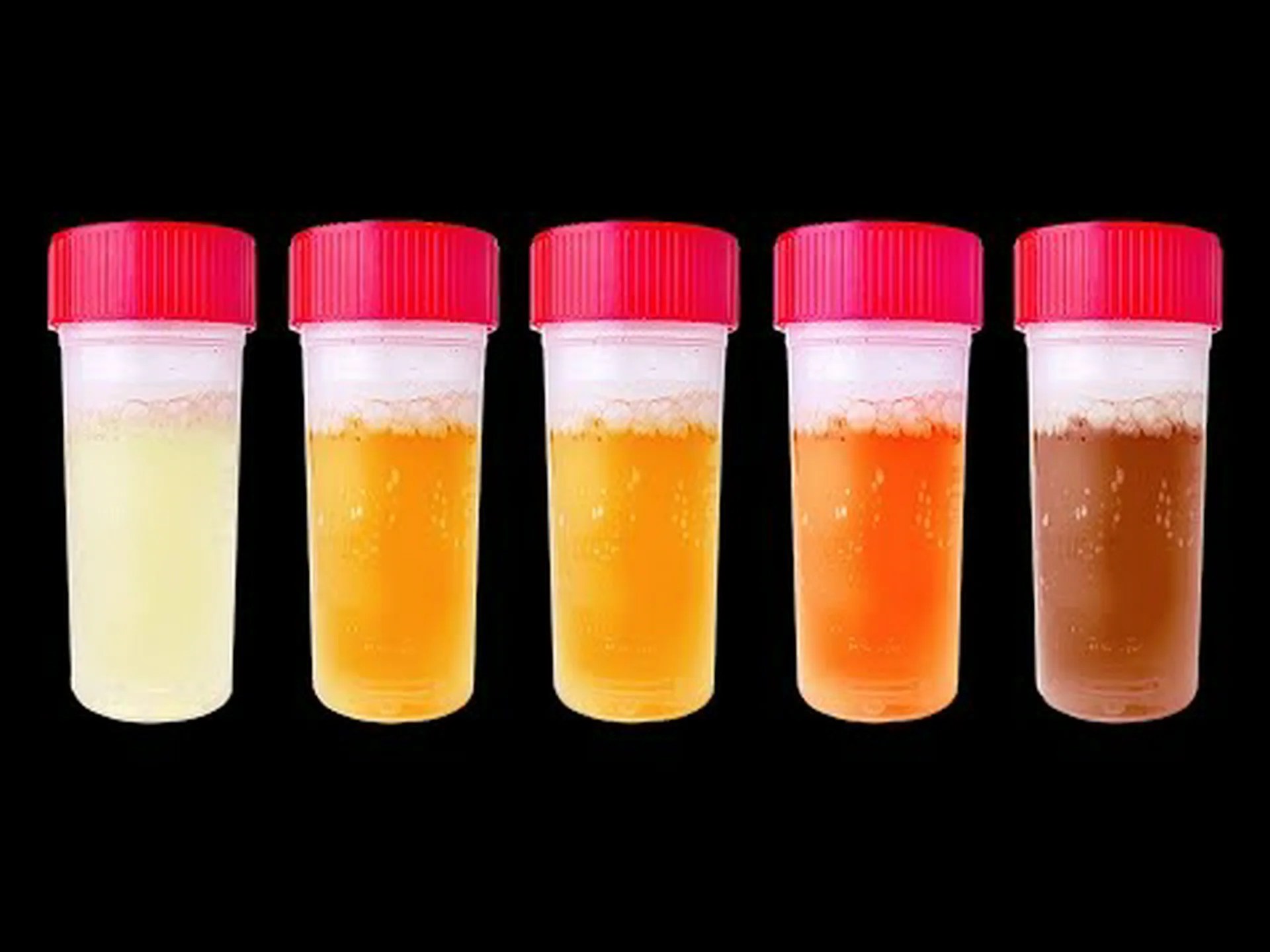 あなたの尿はあなたの健康状態について何を明らかにしますか?注意すべき7つの兆候 あなたの尿はあなたの健康状態について何を明らかにしますか?注意すべき7つの兆候