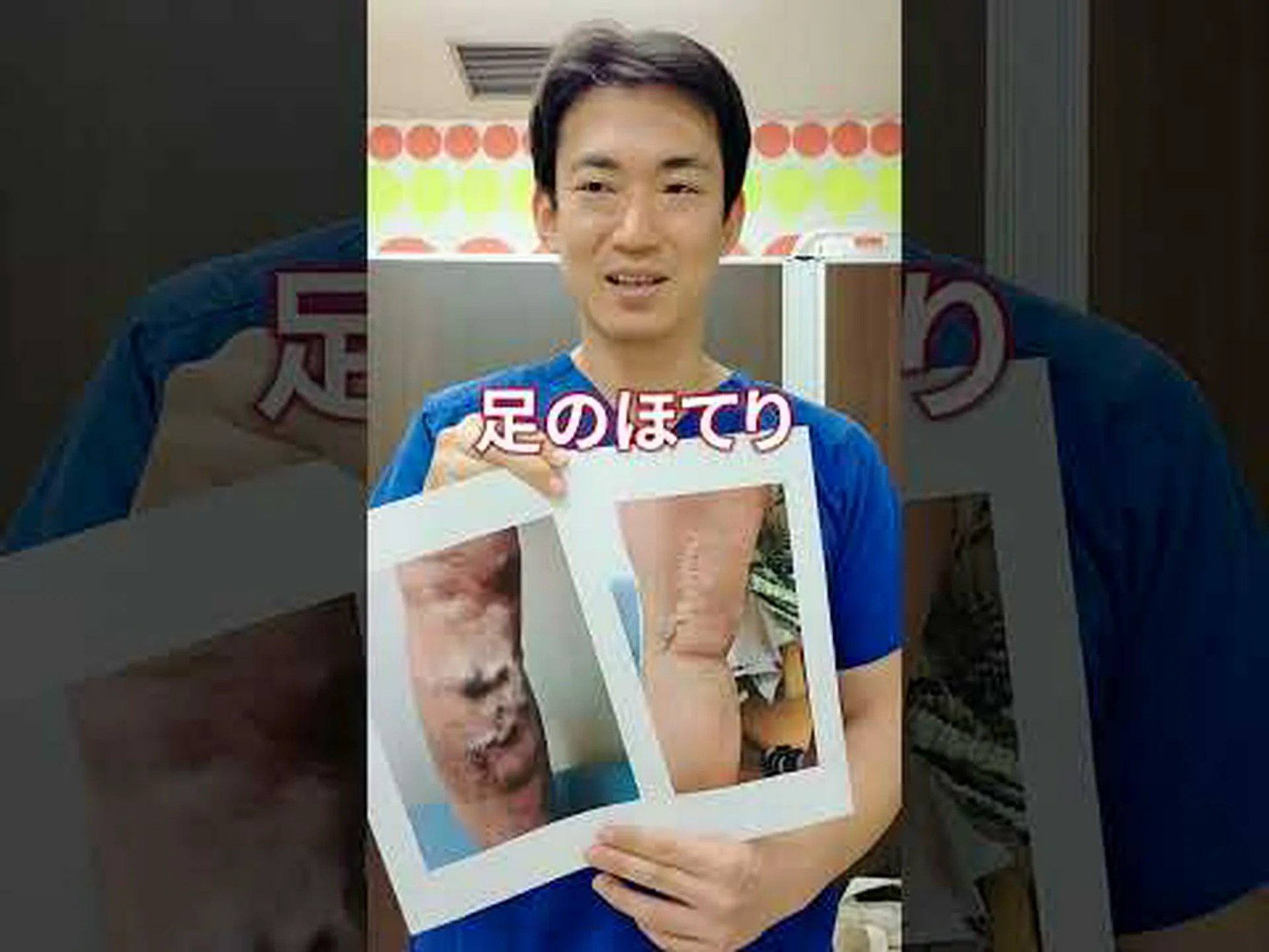 静脈瘤を治療するための運動のヒント 静脈瘤を治療するための運動のヒント