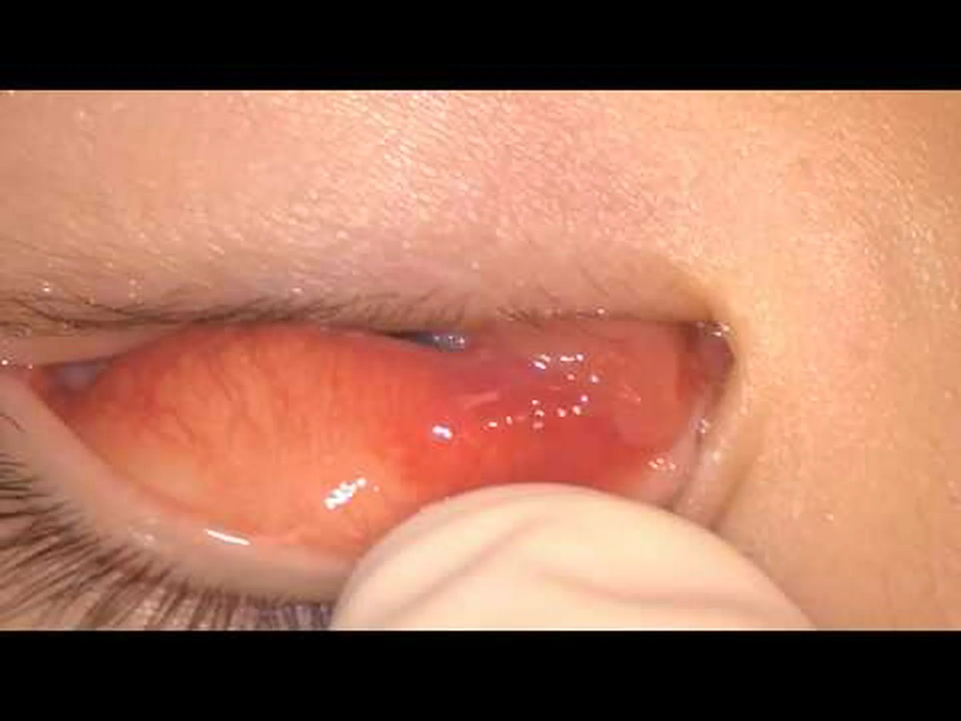 化膿性肉芽腫:その正体、症状、原因、治療法 化膿性肉芽腫:その正体、症状、原因、治療法