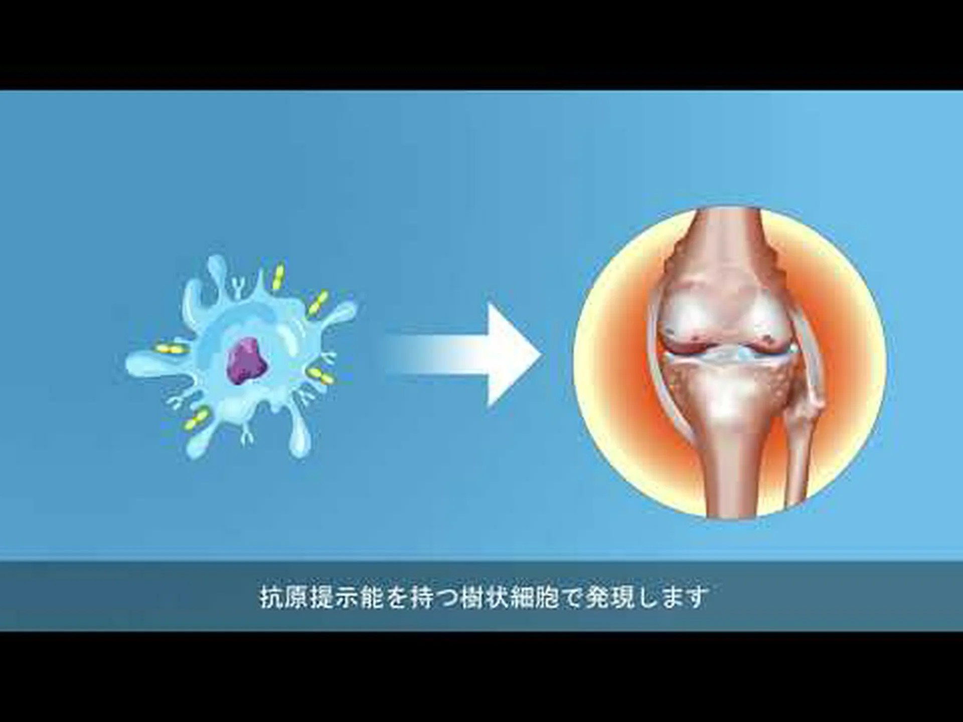 逆ワクチンは硬化症などの自己免疫疾患の治療を期待 逆ワクチンは硬化症などの自己免疫疾患の治療を期待