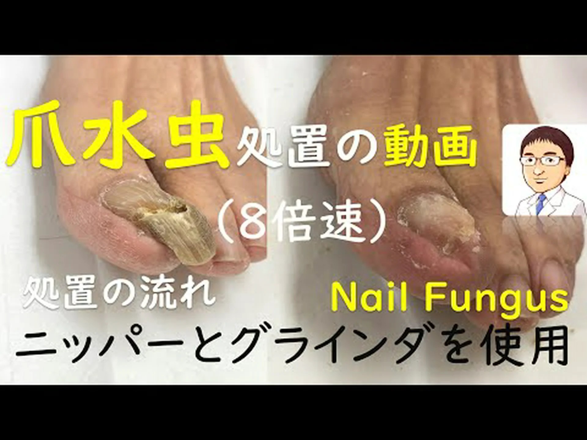白癬はどのようにして皮膚、爪、頭皮に感染するのでしょうか? 白癬はどのようにして皮膚、爪、頭皮に感染するのでしょうか?