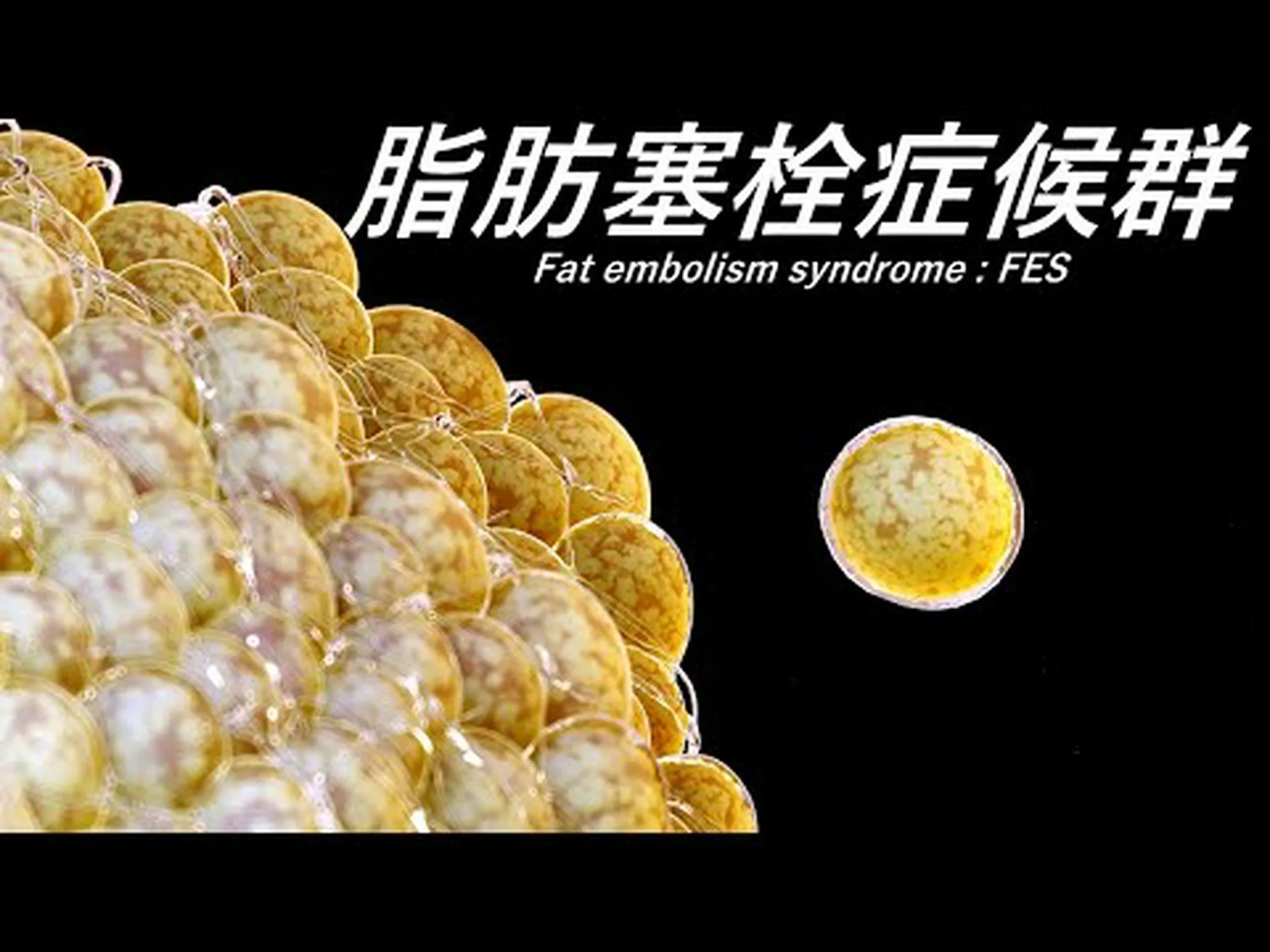 脂肪塞栓症 – 概要、リスク、症状、治療法、原因、ケア 脂肪塞栓症 – 概要、リスク、症状、治療法、原因、ケア