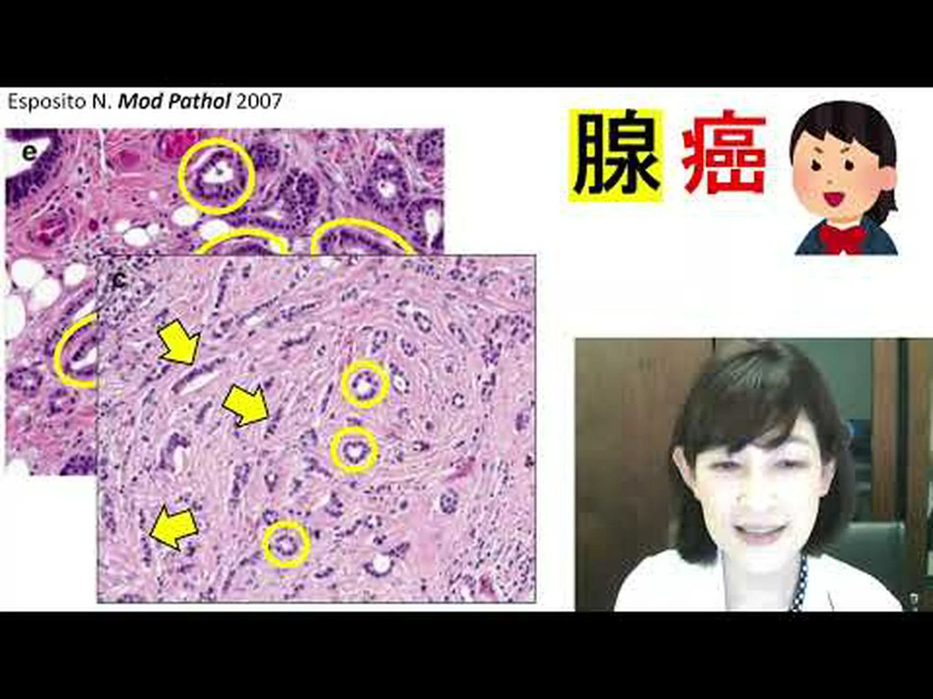 人工知能により乳がんの検出率が 20% 向上し、放射線科医の仕事が支援されます 人工知能により乳がんの検出率が 20% 向上し、放射線科医の仕事が支援されます