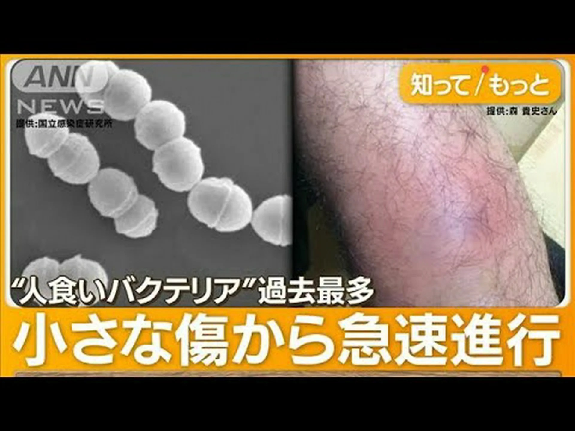 海で足をひっかいて人食いバクテリアに汚染された男性死亡、事件を理解せよ 海で足をひっかいて人食いバクテリアに汚染された男性死亡、事件を理解せよ
