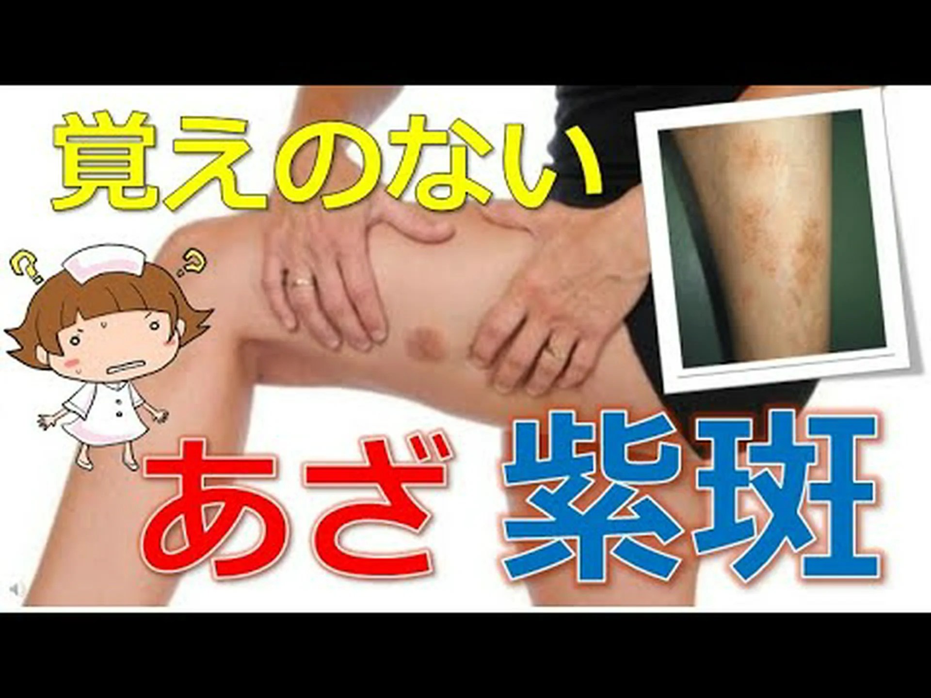 斑状出血 – それは何ですか、原因と治療方法 斑状出血 – それは何ですか、原因と治療方法