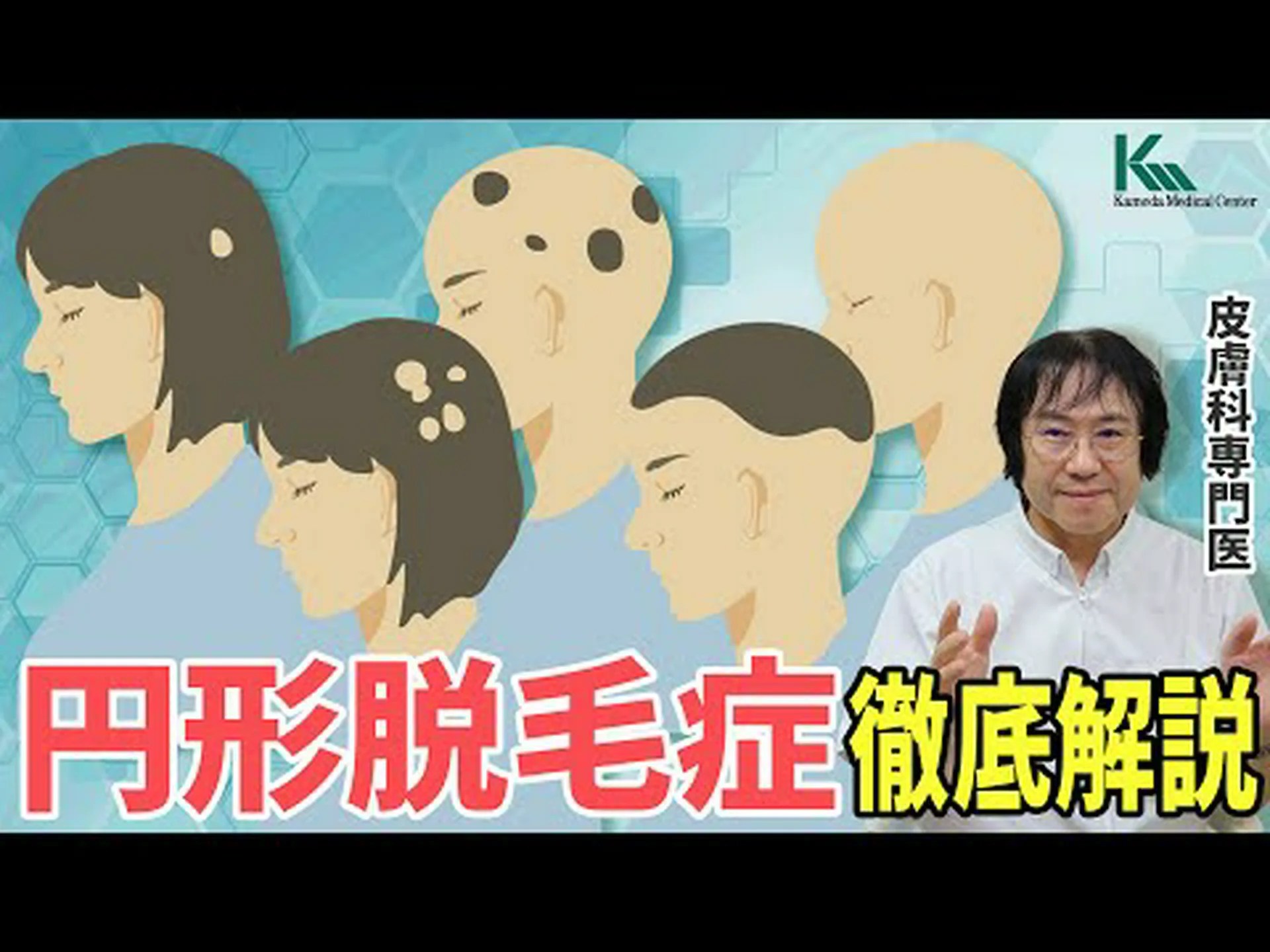 女性の脱毛症:兆候、種類、治療法と予防法 女性の脱毛症:兆候、種類、治療法と予防法