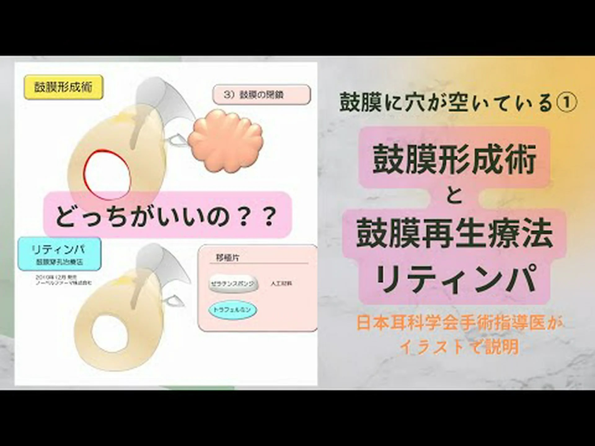歌手アナイのような鼓膜穿孔の原因は何でしょうか? 歌手アナイのような鼓膜穿孔の原因は何でしょうか?