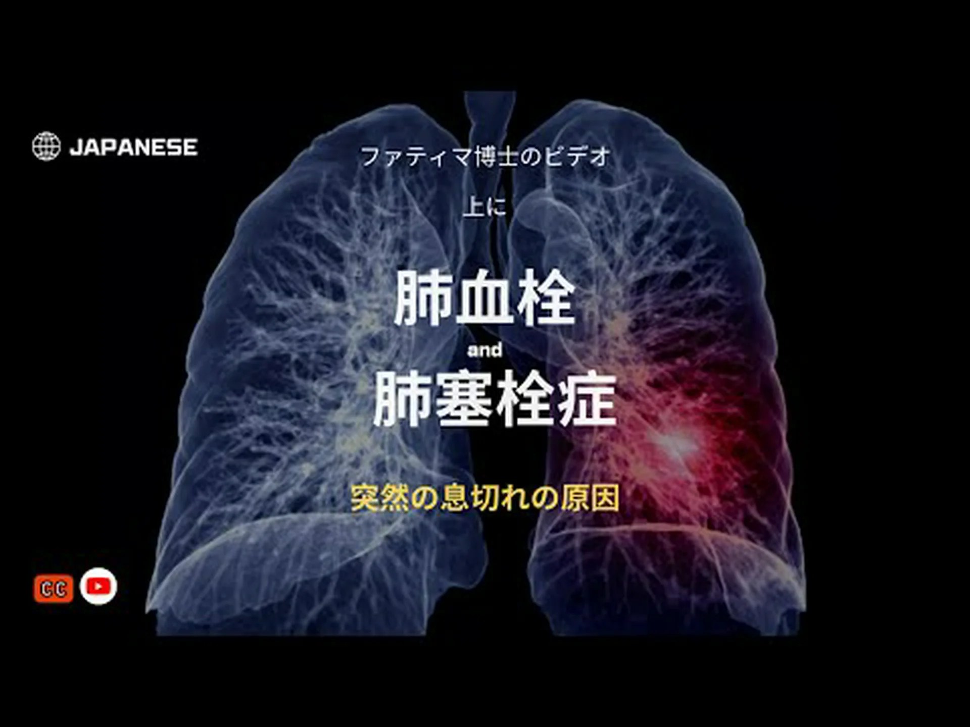 肺塞栓症とは何か、および主な原因 肺塞栓症とは何か、および主な原因