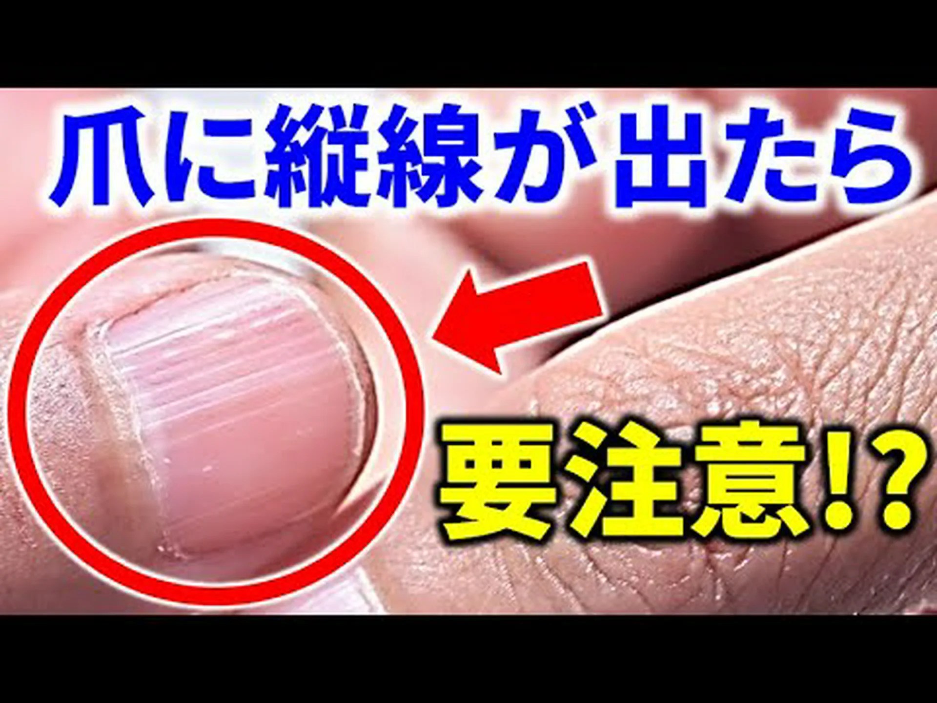 炎症を起こした爪には何が良いのでしょうか? 炎症を起こした爪には何が良いのでしょうか?