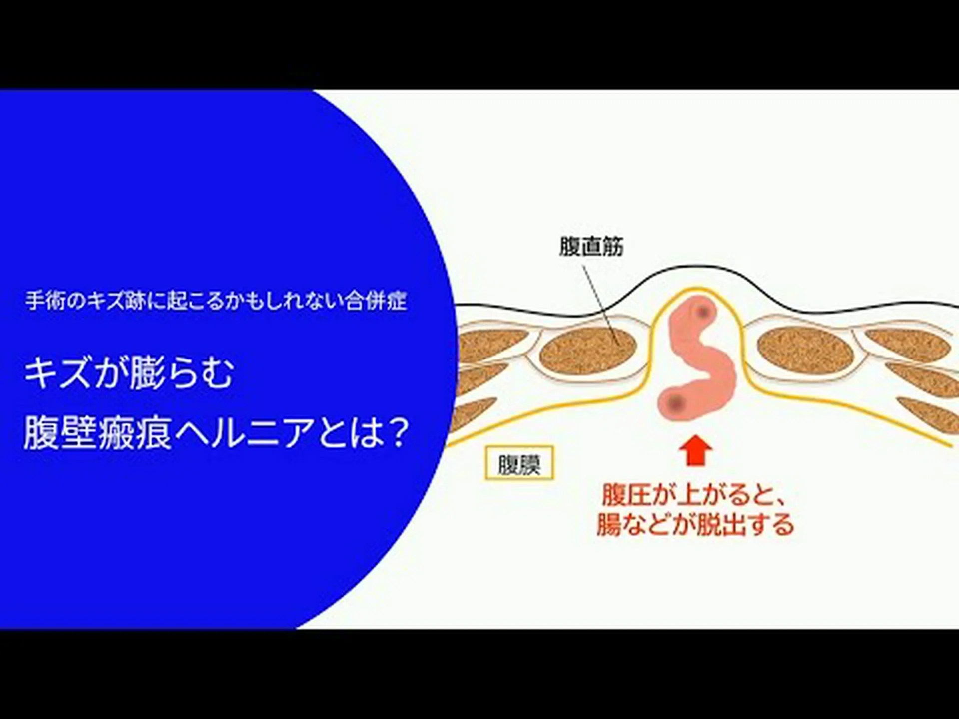 瘢痕ヘルニア:それは何か、症状、原因、治療法 瘢痕ヘルニア:それは何か、症状、原因、治療法