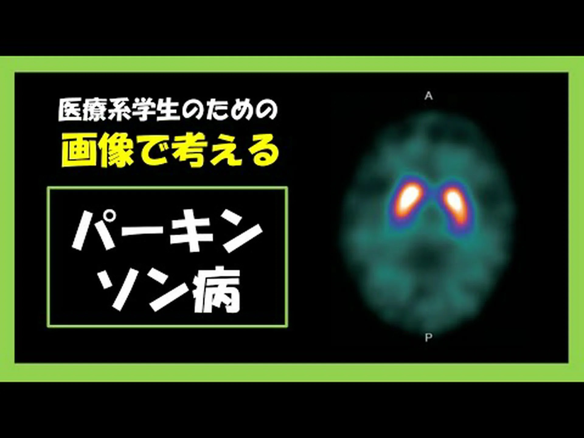 アルツハイマー病とパーキンソン病: 5 人に 1 人がこの病気に対する防御遺伝子を持っています。発見はワクチンにつながる可能性がある アルツハイマー病とパーキンソン病: 5 人に 1 人がこの病気に対する防御遺伝子を持っています。発見はワクチンにつながる可能性がある
