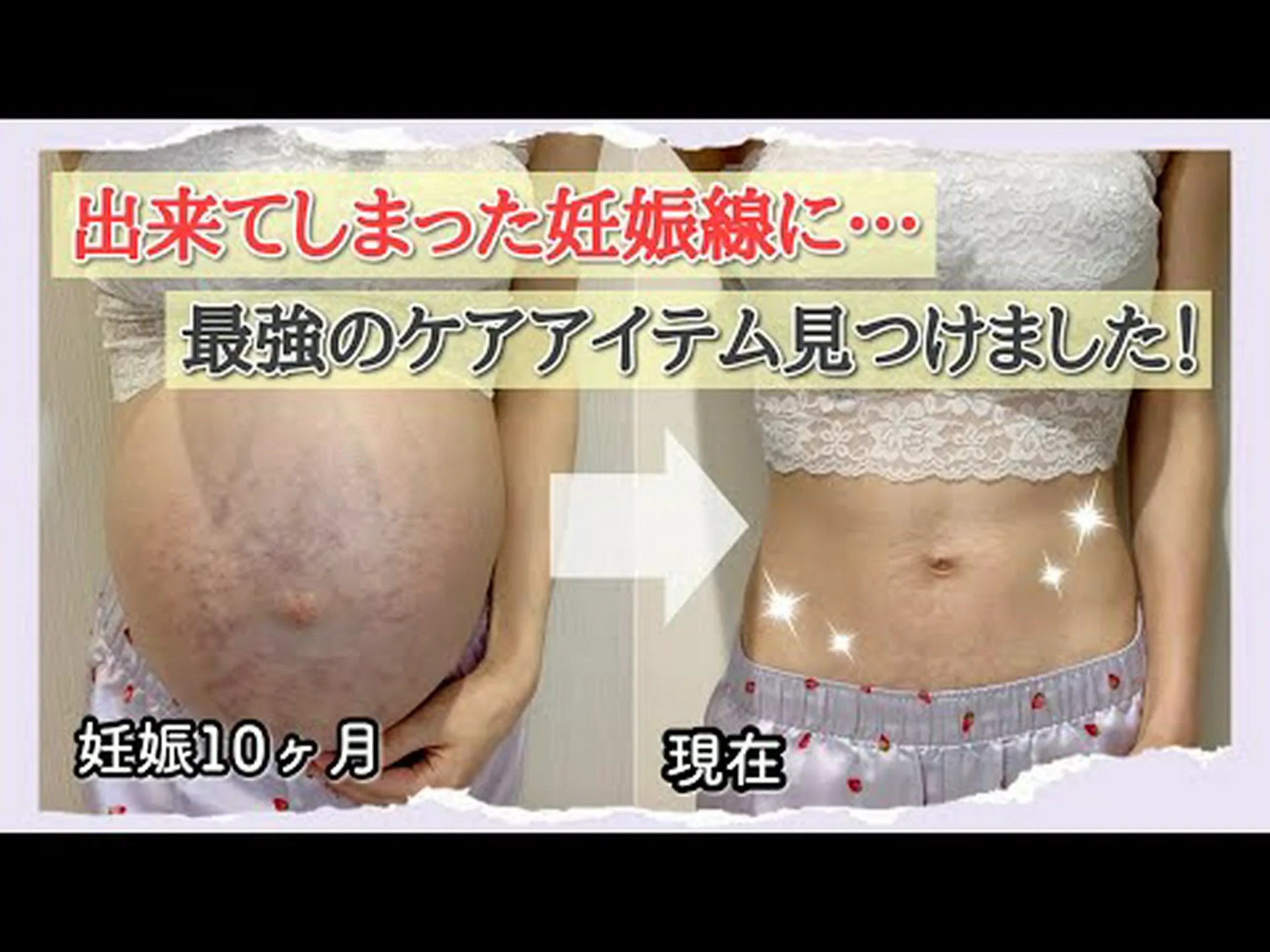ストレッチマークを取り除く方法に関するヒント ストレッチマークを取り除く方法に関するヒント