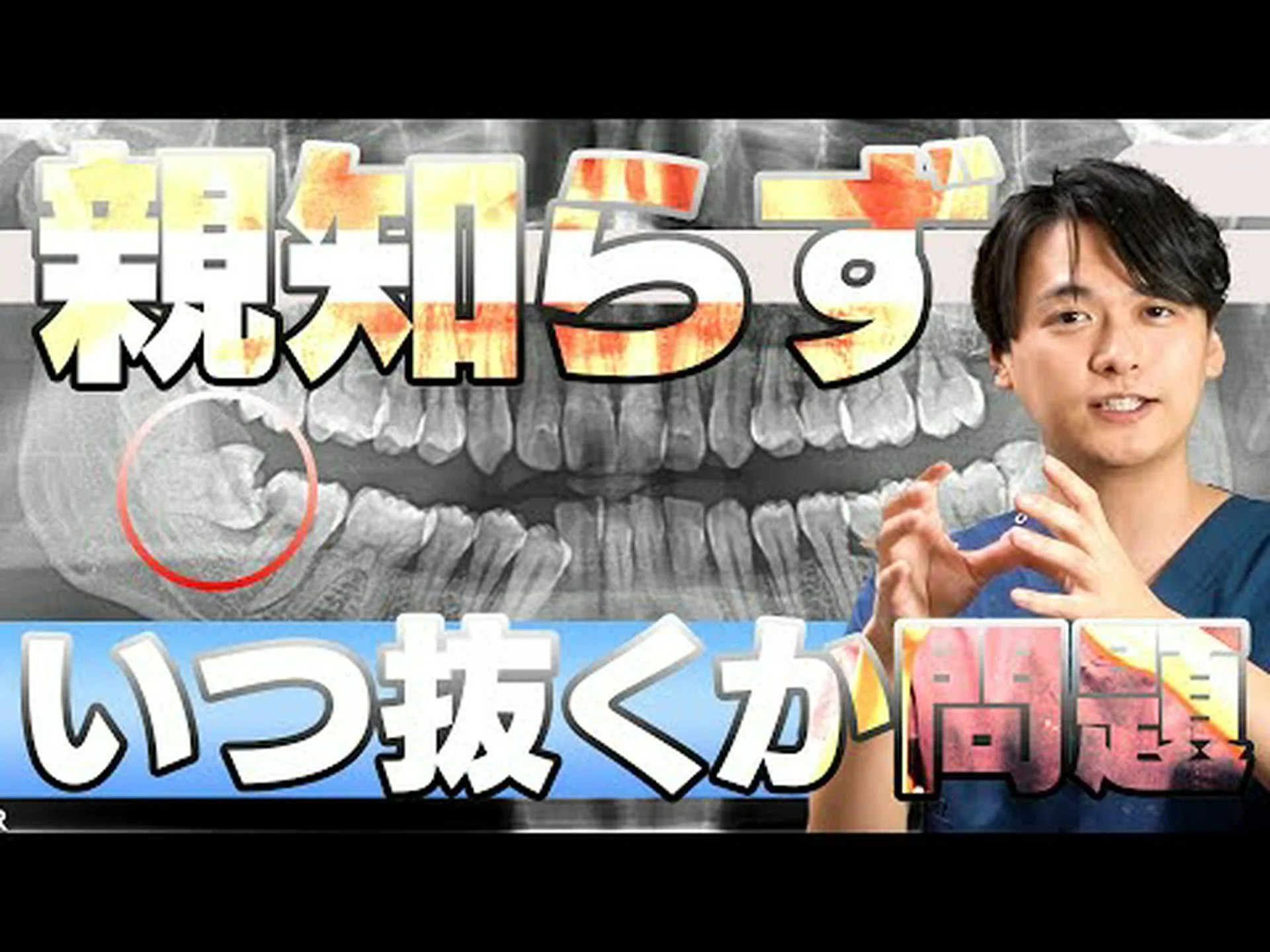 親知らず:症状、いつ抜くべきか、そして回復はどのようなものなのか 親知らず:症状、いつ抜くべきか、そして回復はどのようなものなのか