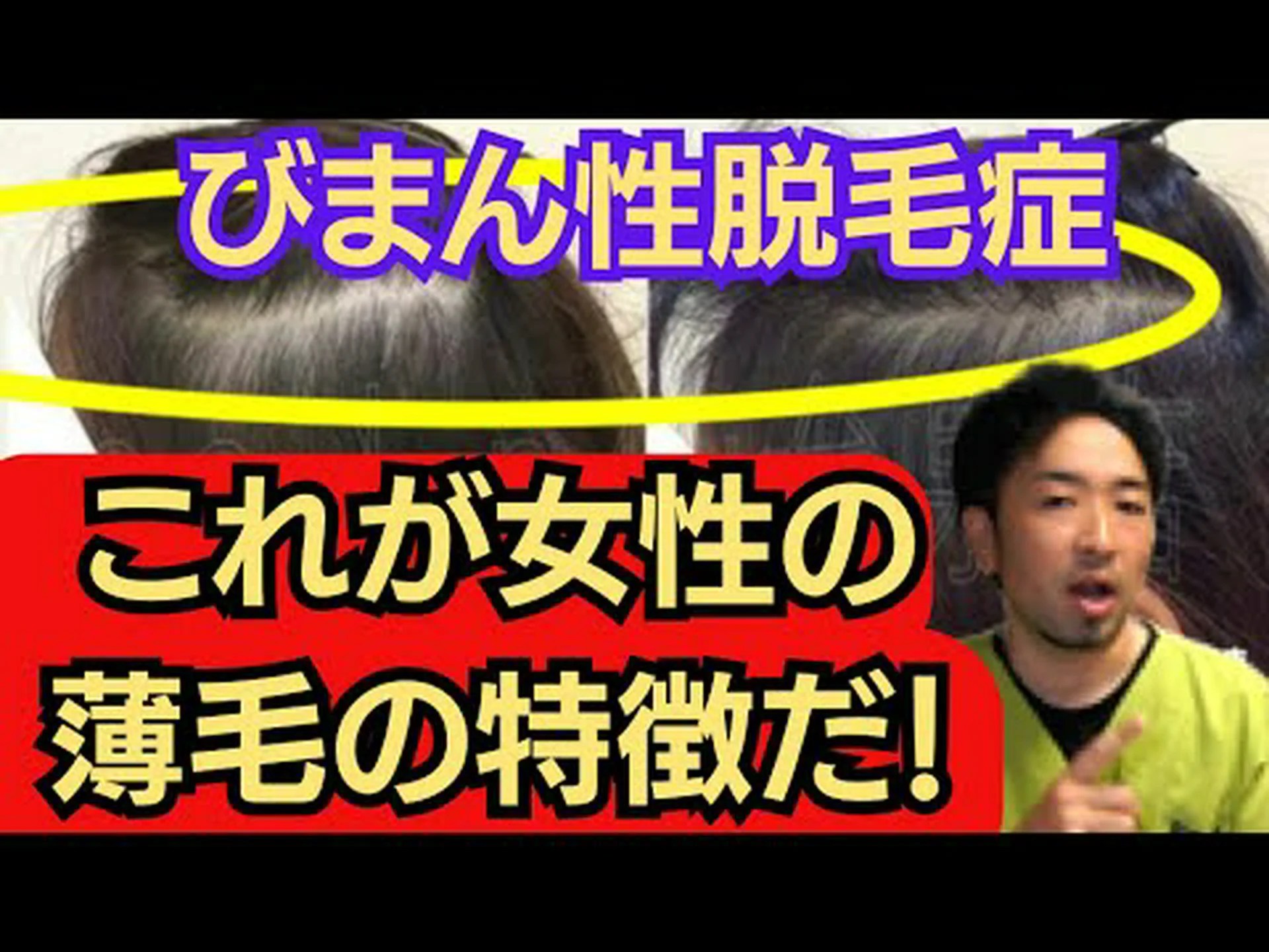 マライーサの後、マイアラさんは脱毛症と診断される マライーサの後、マイアラさんは脱毛症と診断される