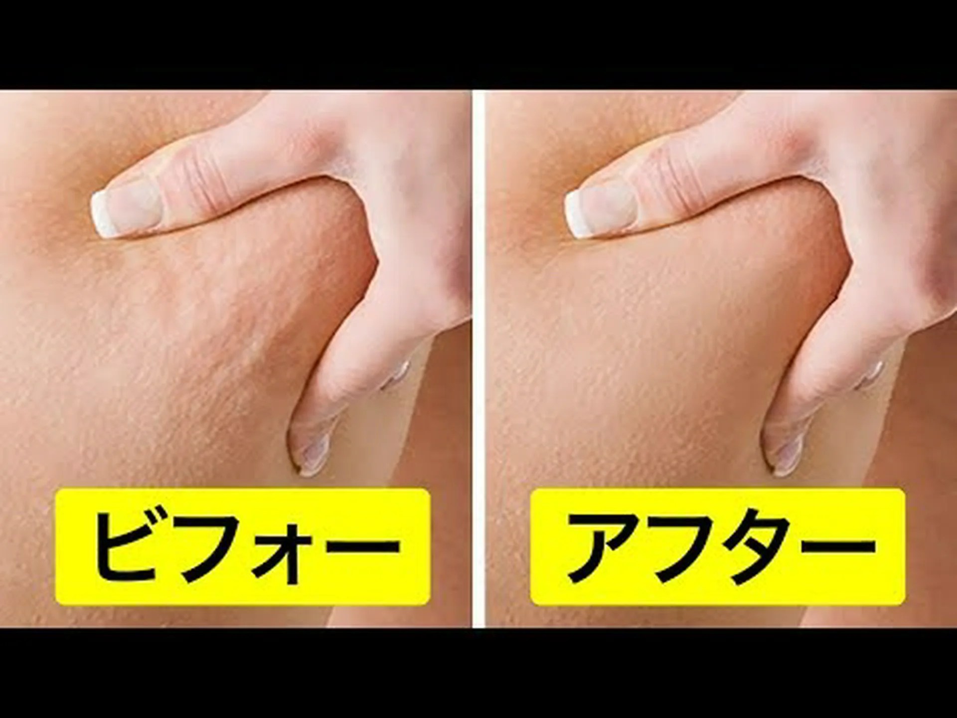 セルライトと戦うための5つのエクササイズ セルライトと戦うための5つのエクササイズ