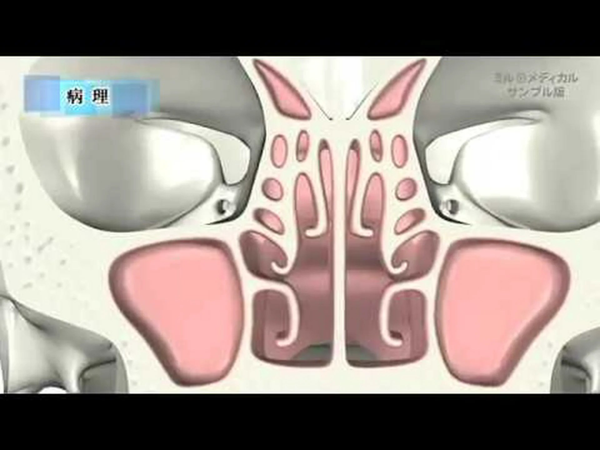 副鼻腔炎で失明寸前になった16歳が意識を高める 副鼻腔炎で失明寸前になった16歳が意識を高める
