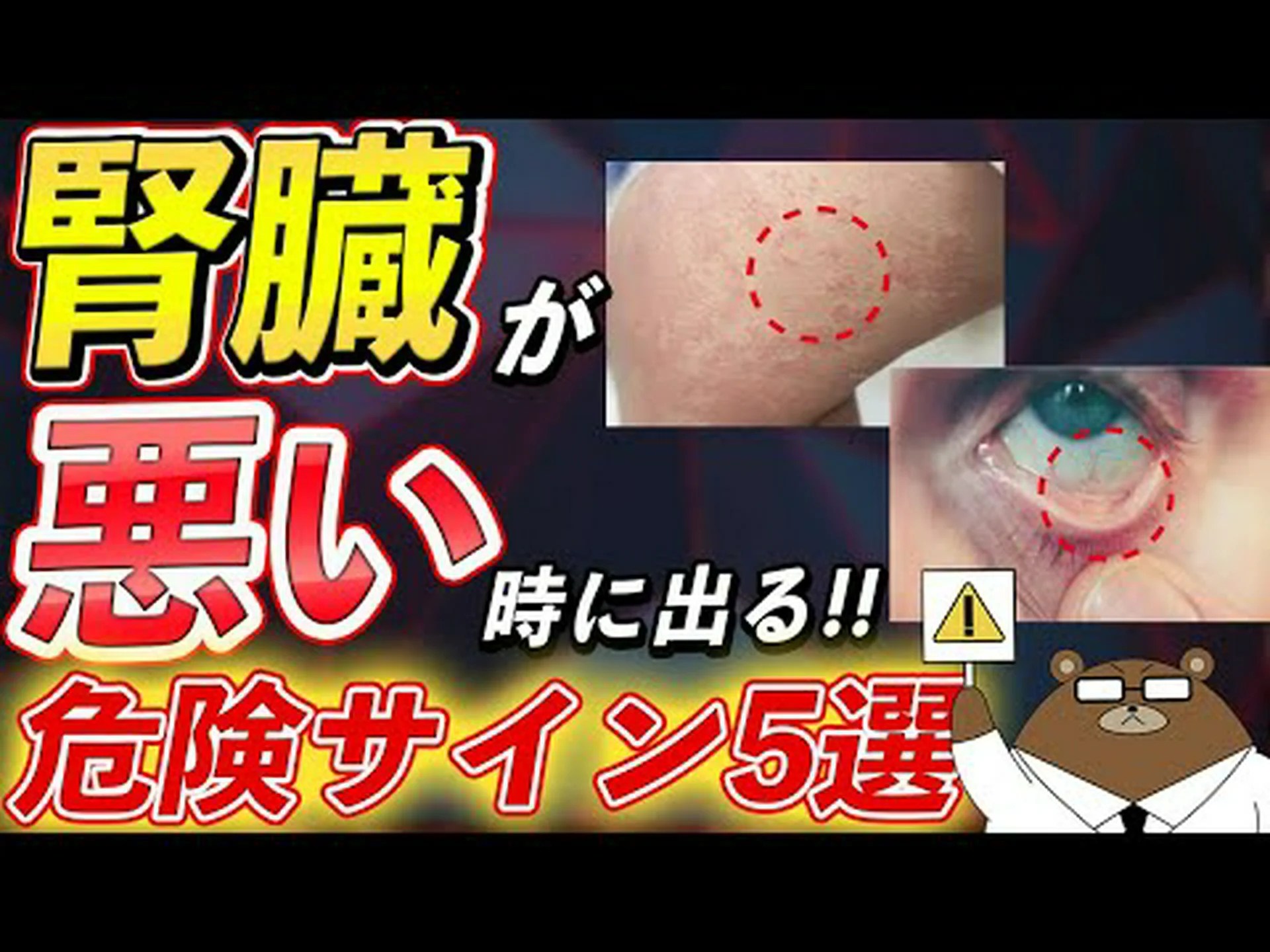 パルミリーニャおばあちゃん、慢性腎臓病で死亡 – 臓器の調子が悪いことを示す症状を調べてください パルミリーニャおばあちゃん、慢性腎臓病で死亡 – 臓器の調子が悪いことを示す症状を調べてください