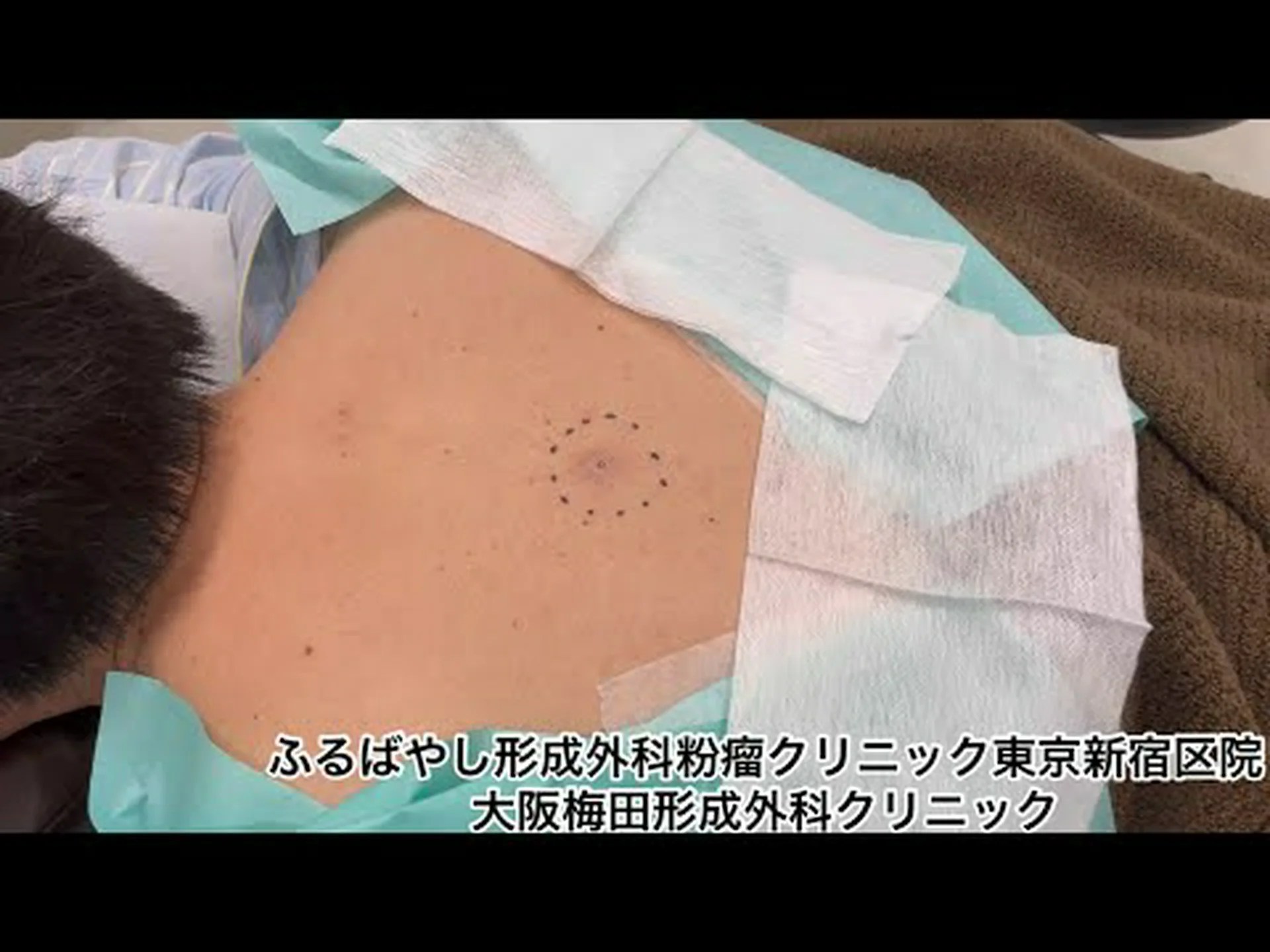 腹部形成手術とはどのようなものですか? 腹部形成手術とはどのようなものですか?