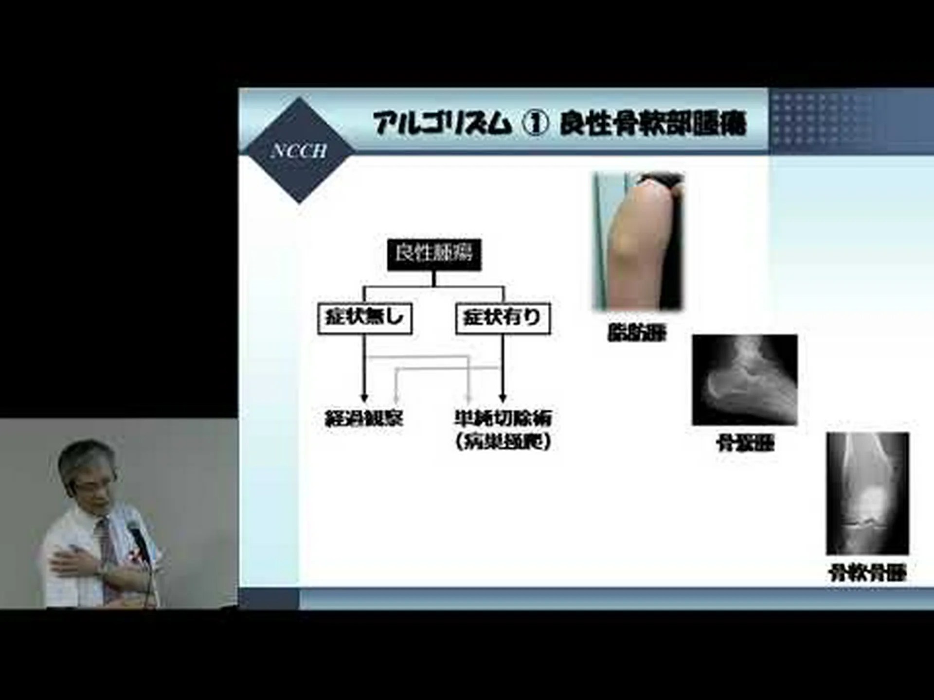 脂肪肉腫:それは何か、診断、種類、治療 脂肪肉腫:それは何か、診断、種類、治療