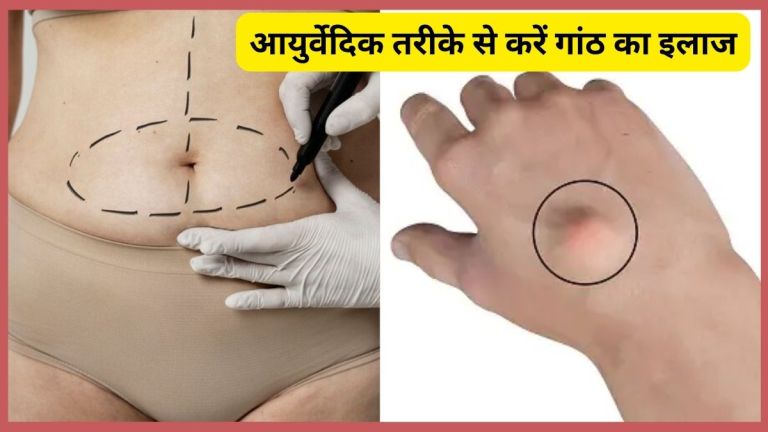 कैंसर की नहीं बल्कि चर्बी की भी होती है गांठ, आयुर्वेदिक नुस्खा ही कर देगा असर, चंद दिनों में घुल जाएगी गांठों की चर्बी “ • ˌ कैंसर की नहीं बल्कि चर्बी की भी होती है गांठ, आयुर्वेदिक नुस्खा ही कर देगा असर, चंद दिनों में घुल जाएगी गांठों की चर्बी “ • ˌ