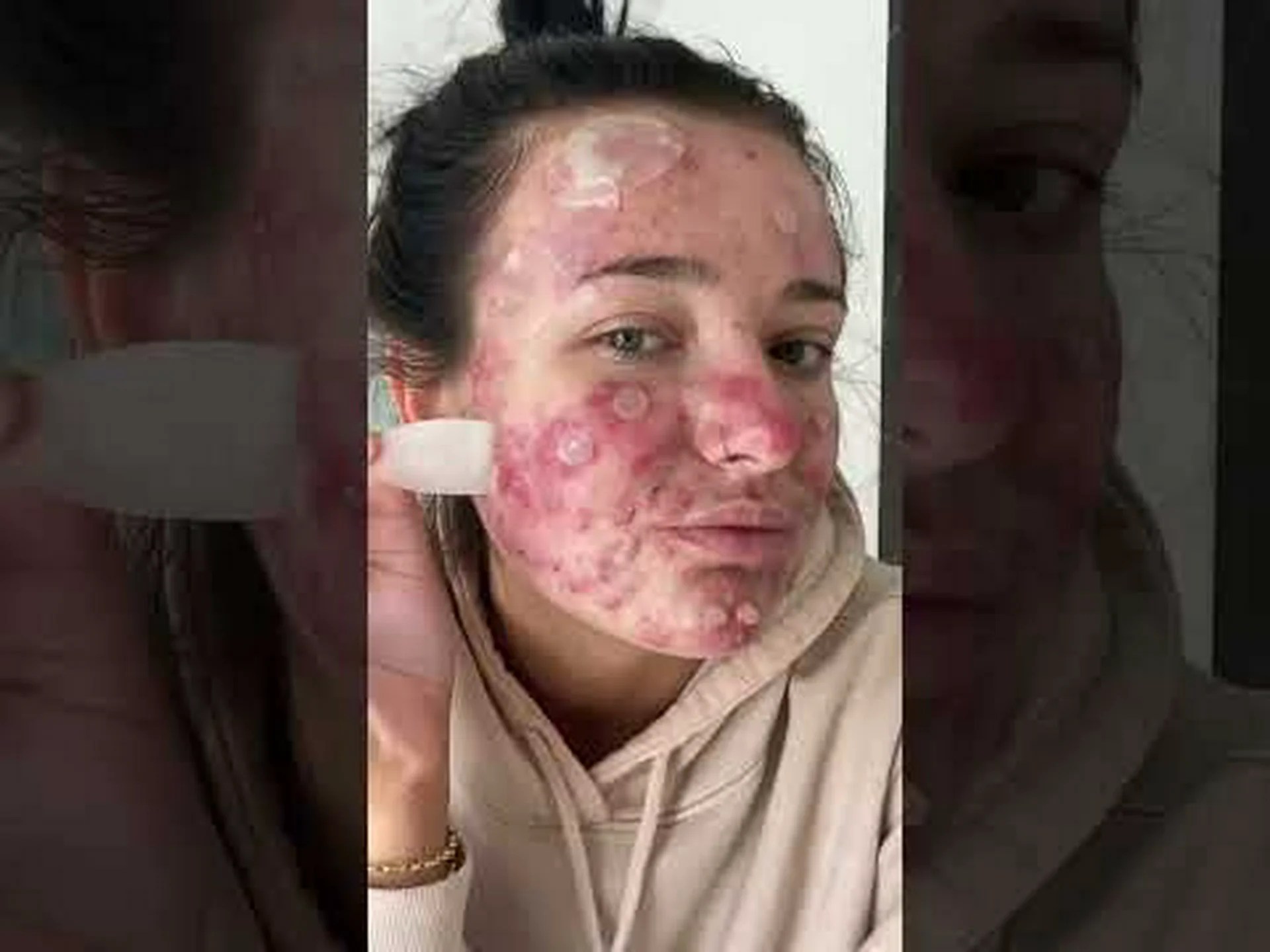 Korean pimple patches Korean pimple patches