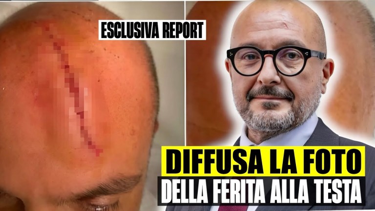 ULTIM’ORA: DIFFUSA LA FOTO DELLA FERITA DEL MINISTRO SAN GIULIANO DOPO LA LITE CON LA BOCCIA ULTIM’ORA: DIFFUSA LA FOTO DELLA FERITA DEL MINISTRO SAN GIULIANO DOPO LA LITE CON LA BOCCIA