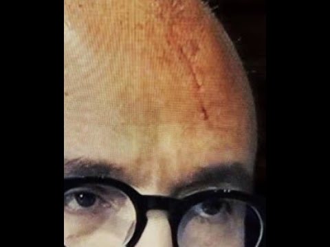 SANGIULIANO PICCHIATO, MISTERO SU FERITE CHE HA SUL CAPO. SANGIULIANO PICCHIATO, MISTERO SU FERITE CHE HA SUL CAPO.