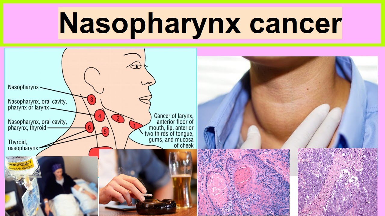 Nasopharyngeal Cancer: Symptoms, Causes & Treatment Nasopharyngeal Cancer: Symptoms, Causes & Treatment